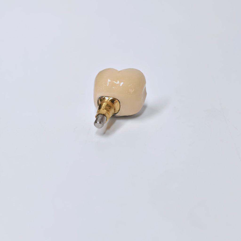 PFM Crown With Screw Retained