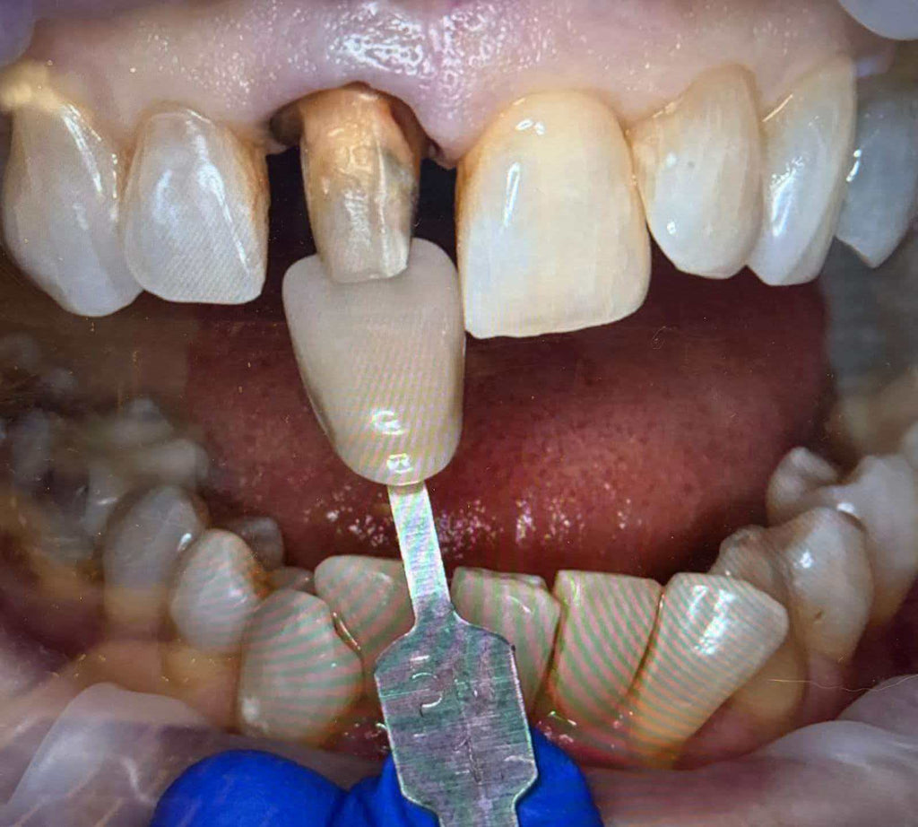 PFZ High Aesthetics Crown Dental Lab