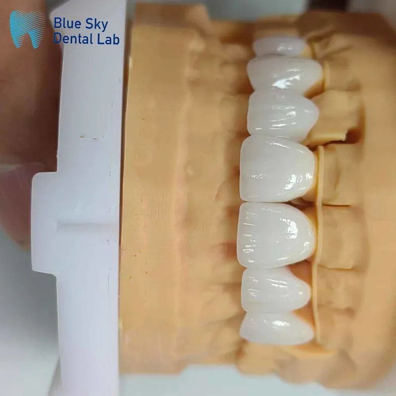 PFZ Porcelain Fused Zirconia Aidite Zirconia Affordable Dental Lab