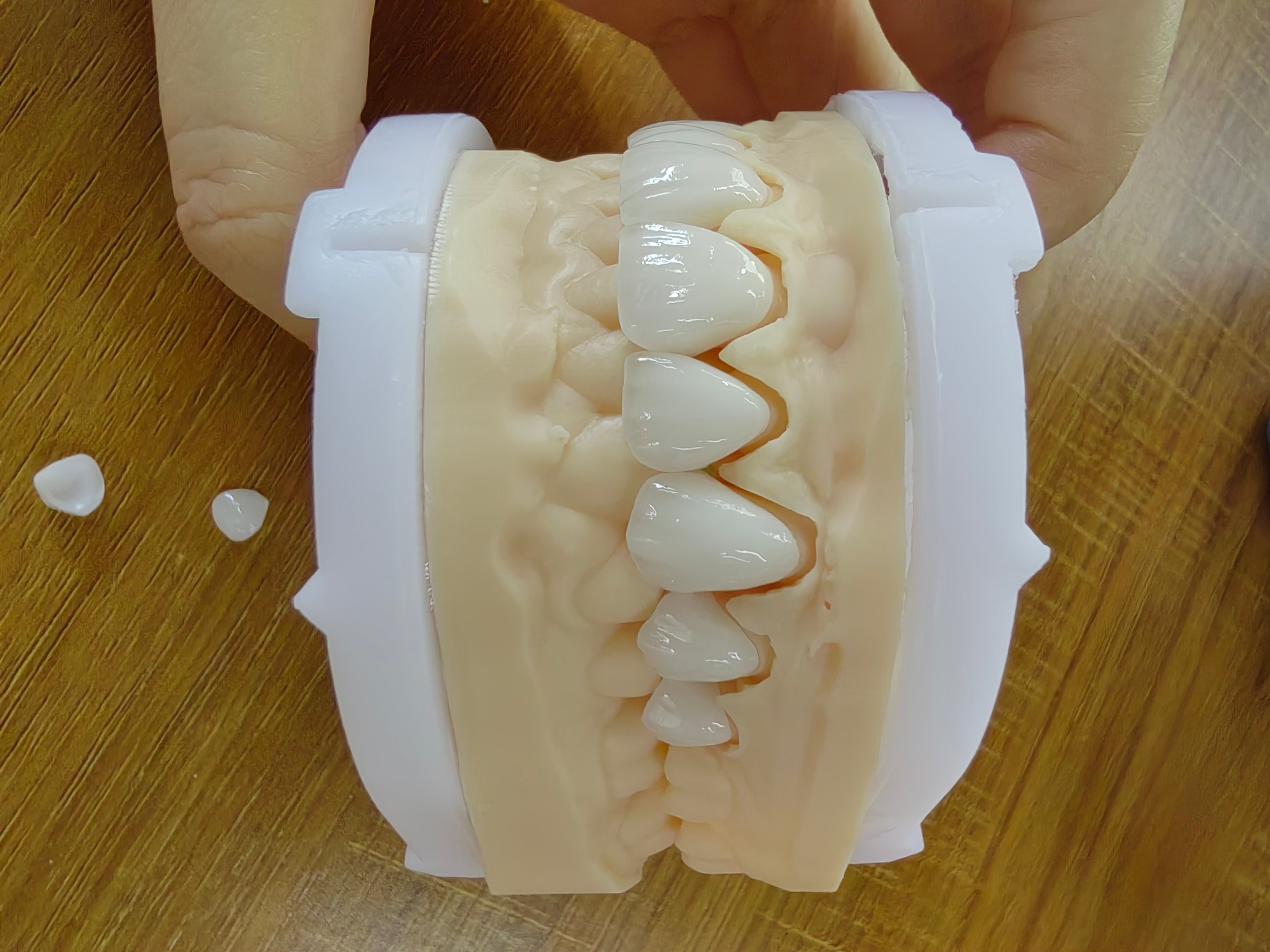 PFZ Zirconia Crowns And Bridge