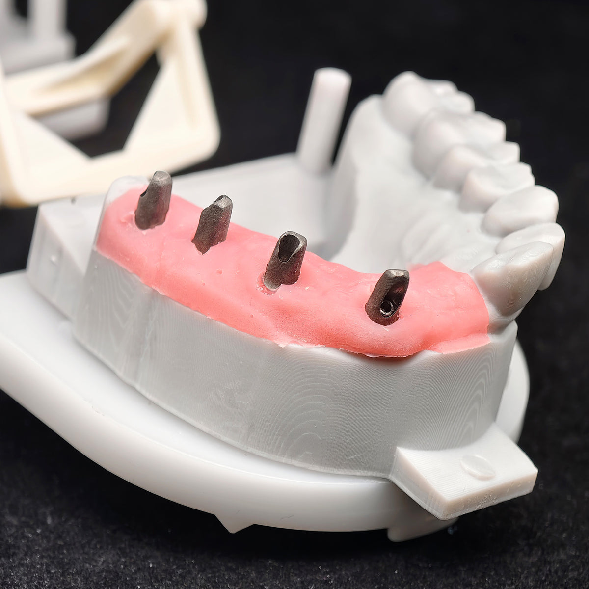PMMA Bridge With Custom Abutment And Implant Seating Guide