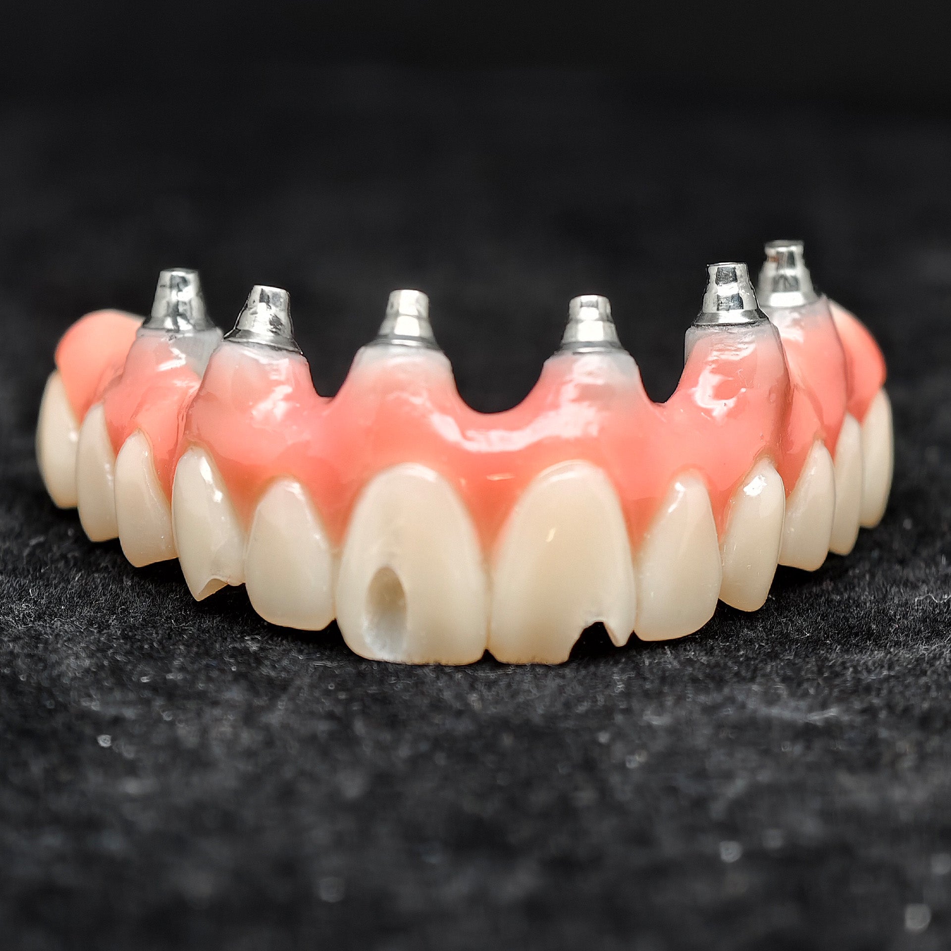Pmma Bridge With Screw-Retained