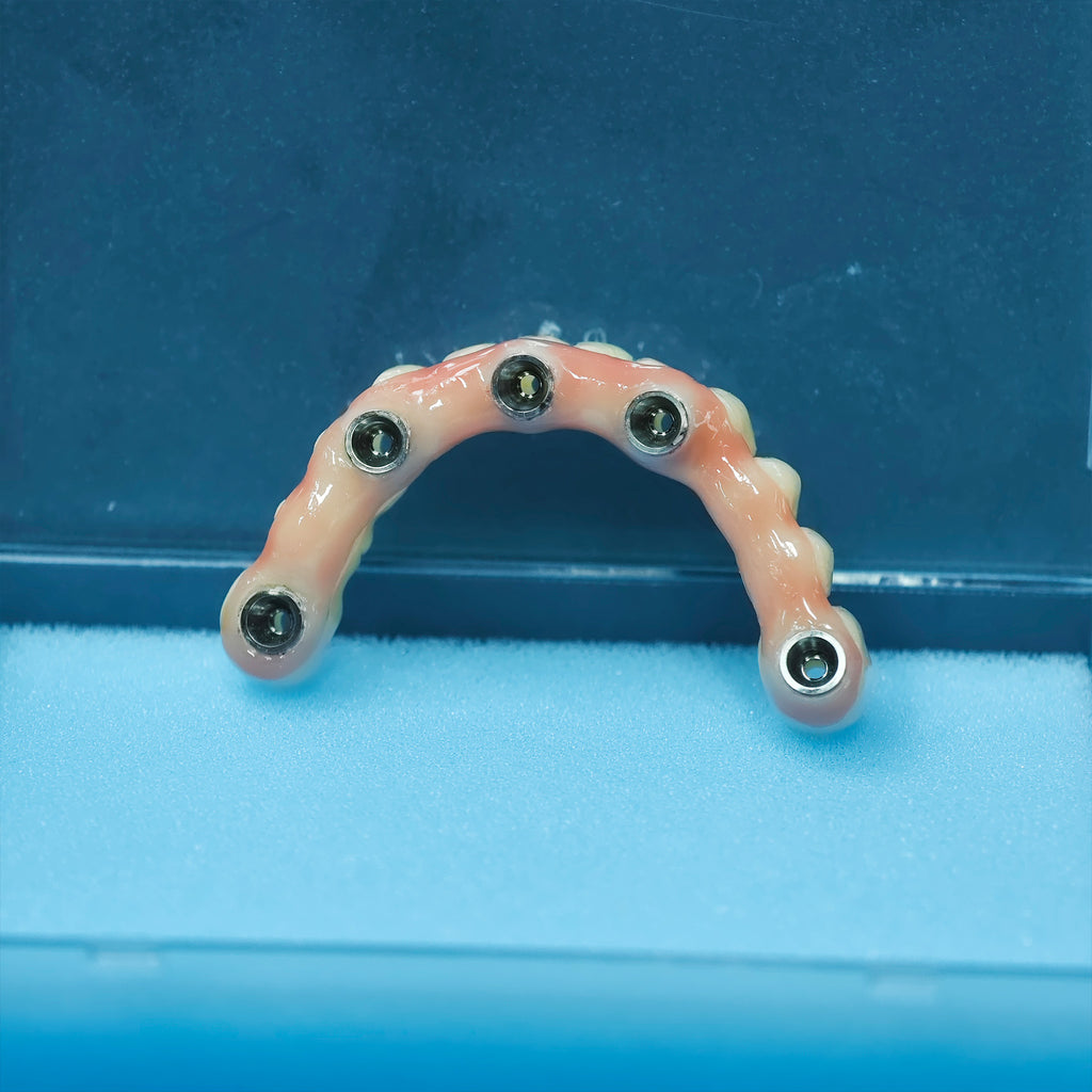 PMMA Bridge With Screw Retained