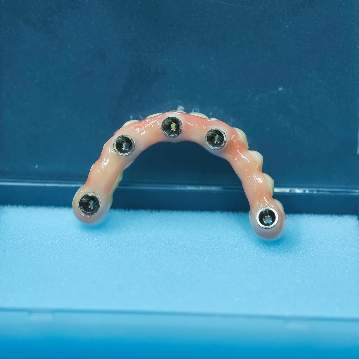 PMMA Bridge With Screw Retained