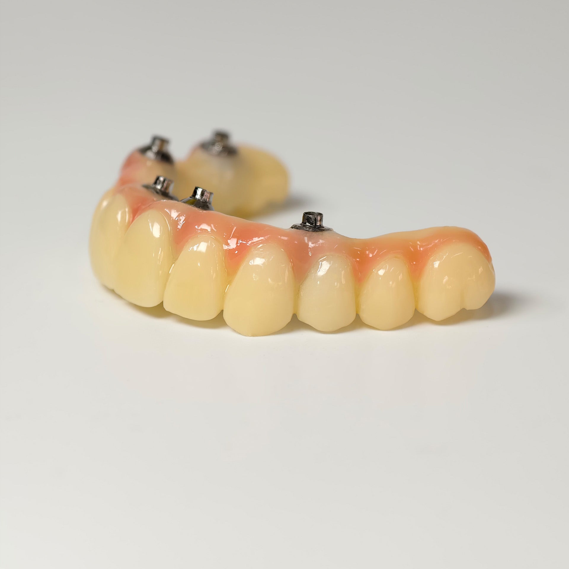 PMMA Bridge With Screw Retained