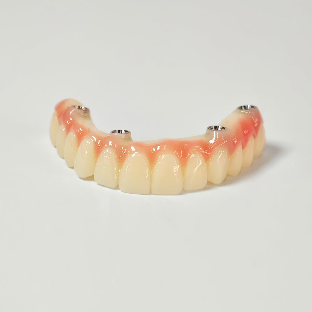 PMMA Bridge With Screw Retained