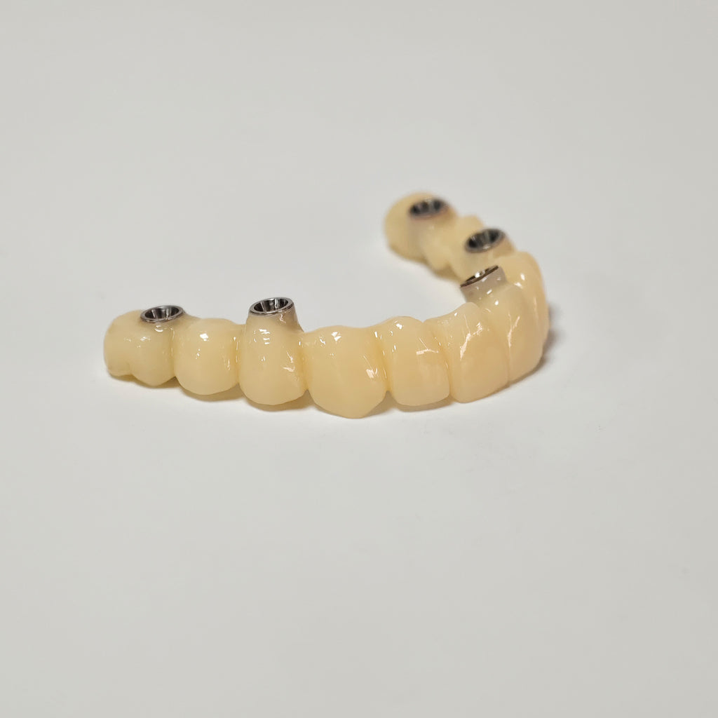 PMMA Bridge With Screw Retained