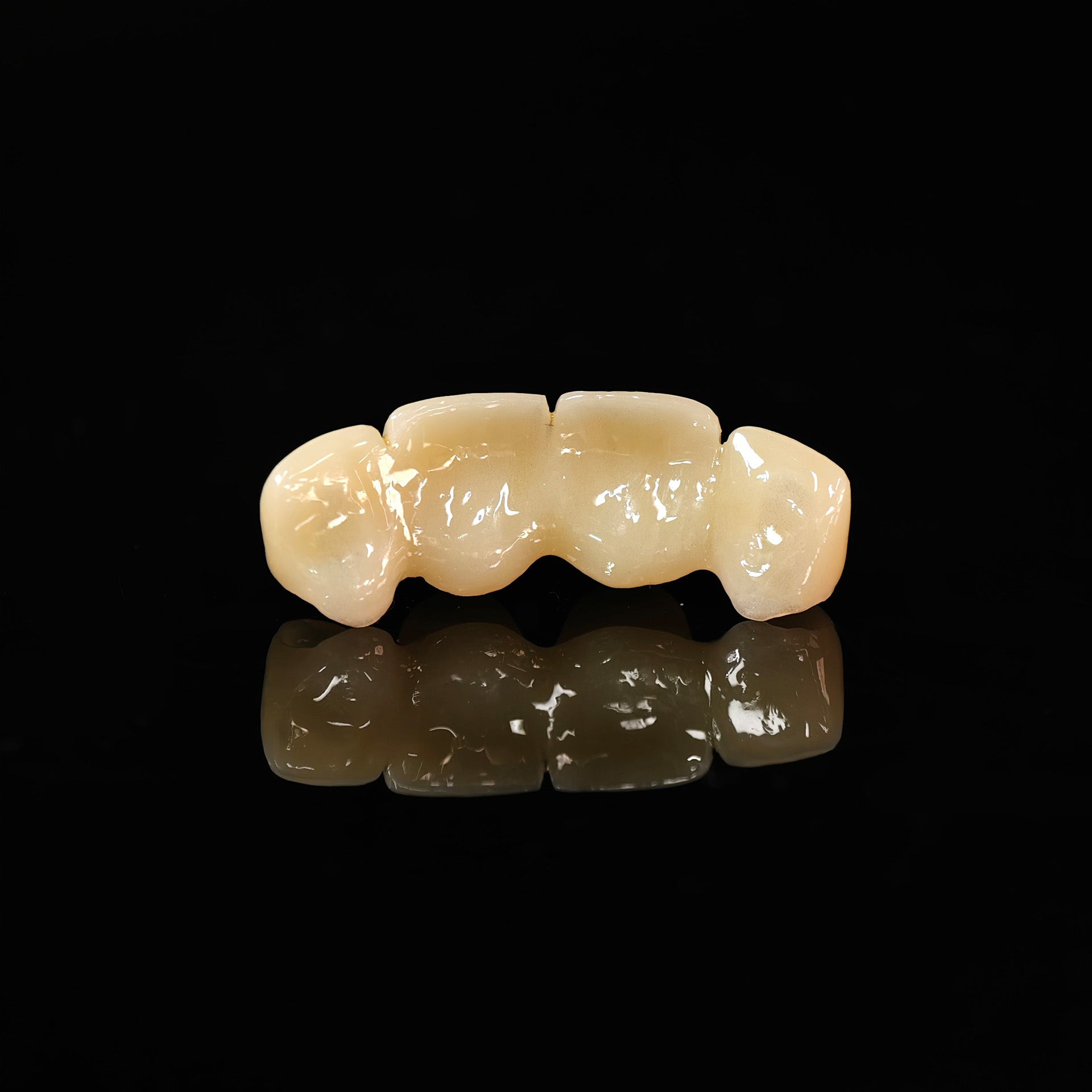 Pmma Bridge With Cement Retained