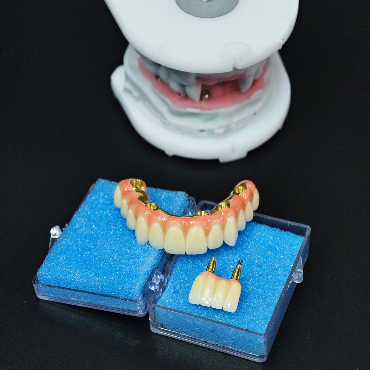 Ti-Bar Titanium Nitride Metal Frame With Zirconia Bridge For Full Arch Restoration