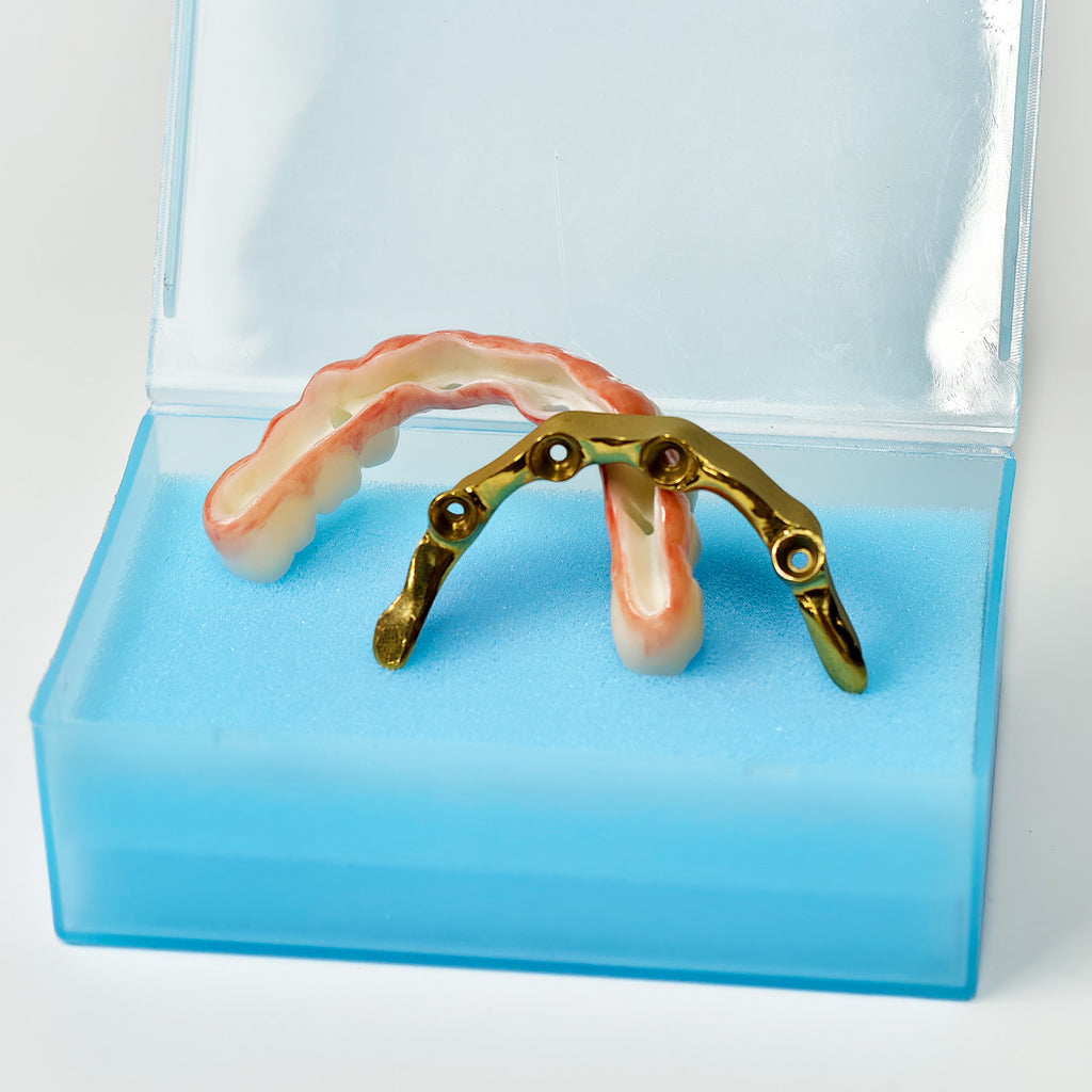 Ti-Bar Titanium Nitride Metal Frame With Zirconia Bridge For Full Arch Restoration