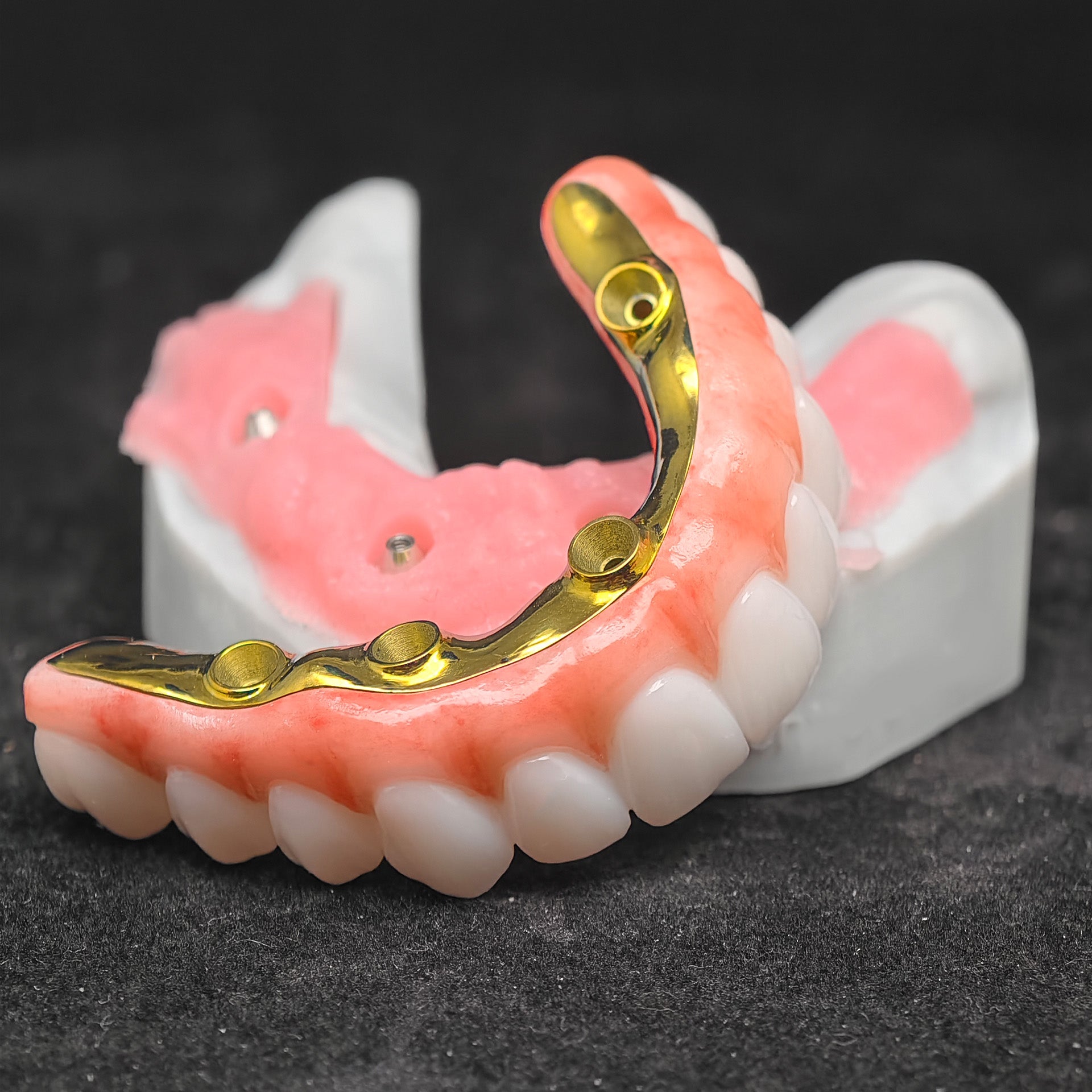 Ti-Bar Titanium Nitride Metal Frame With Zirconia Bridge For Full Arch Restoration