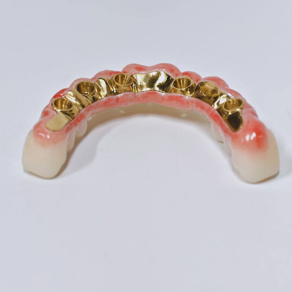 Ti-Bar Titanium Nitride Metal Frame With Zirconia Bridge For Full Arch Restoration