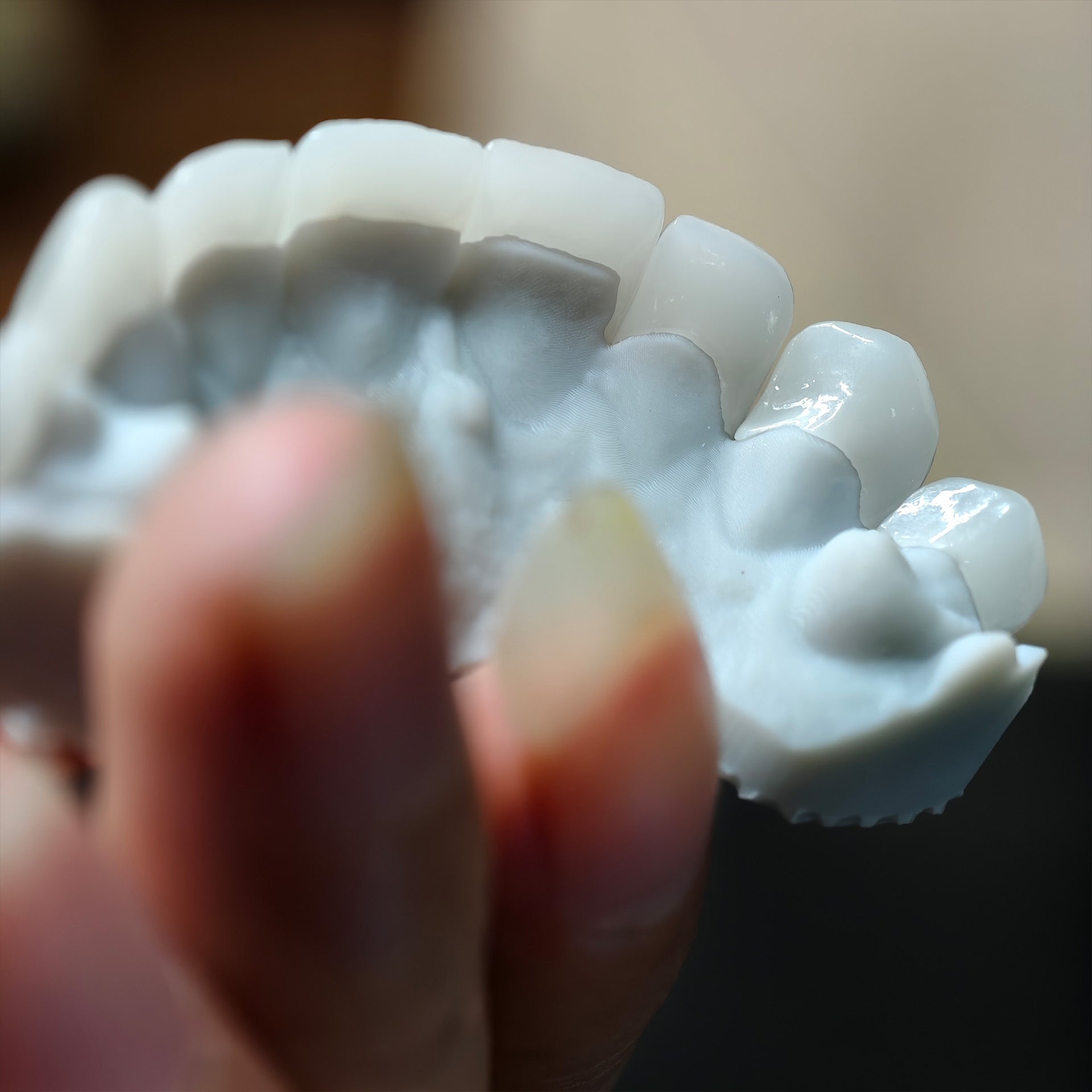Ultra-Thin Emax Veneer. High Transparency/Translucent, Natural Shade