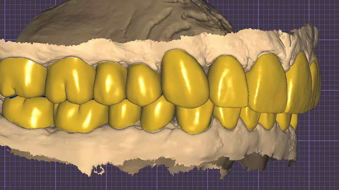 Upper And Lower Smile Design