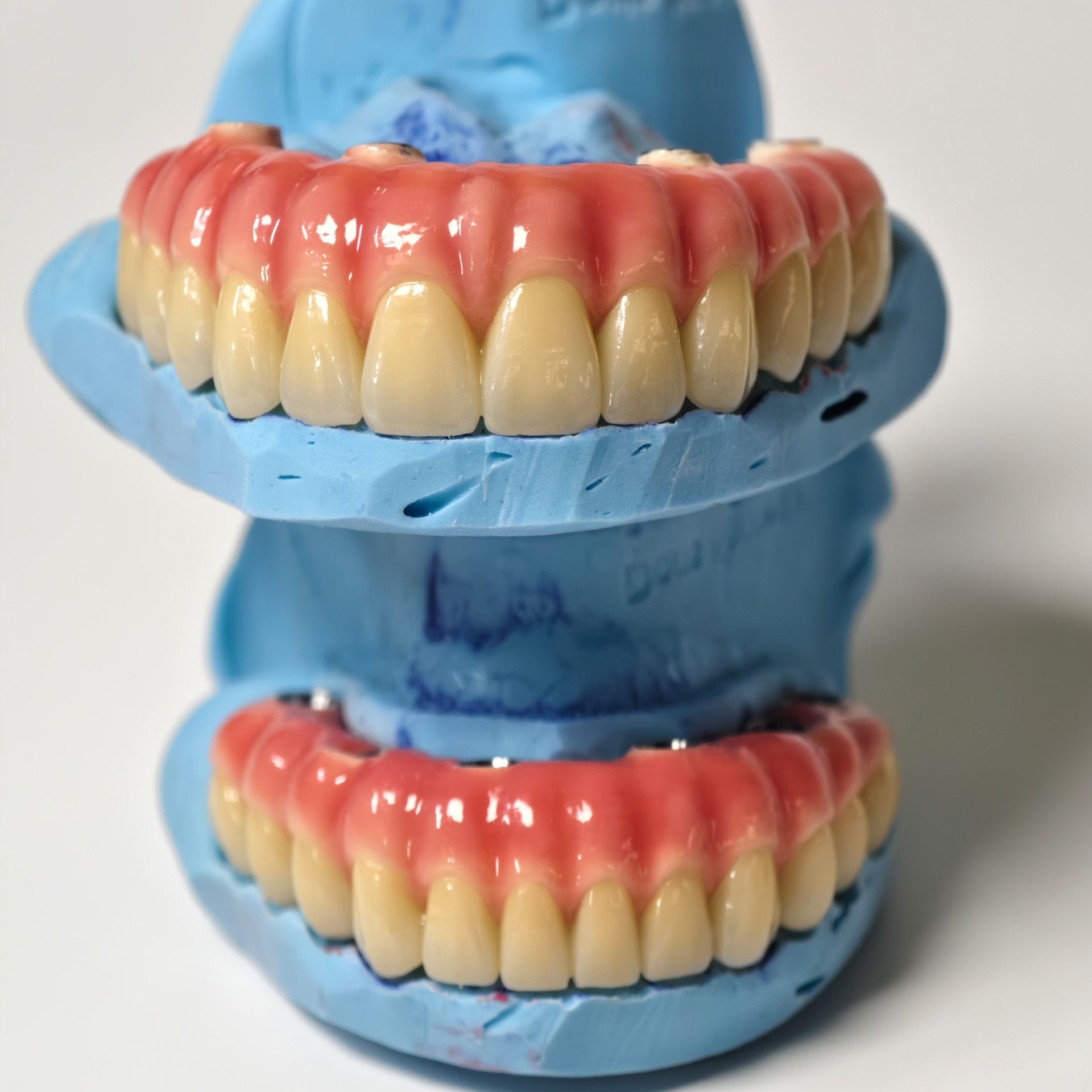 Zirconia-Enamel Hybrid Malo Bridge