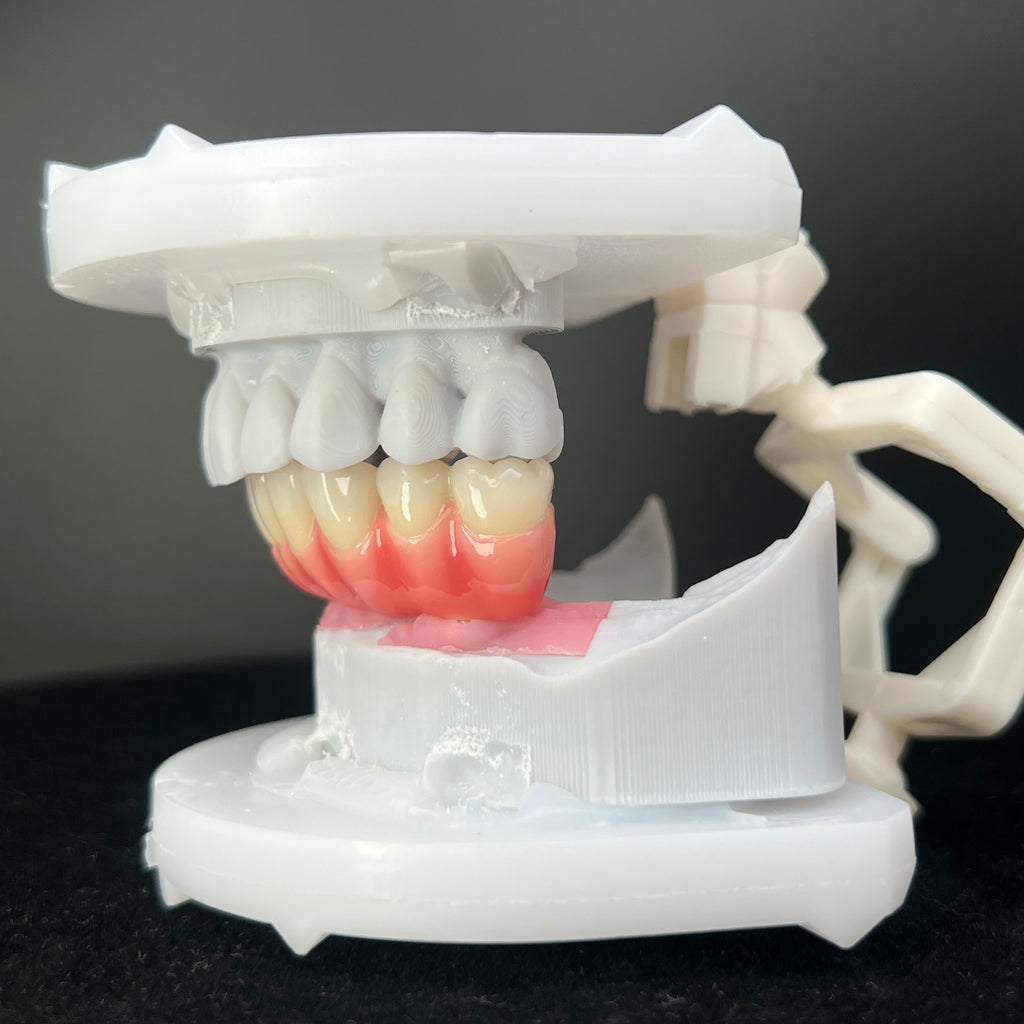 Zirconia-Enamel Hybrid Malo Bridge