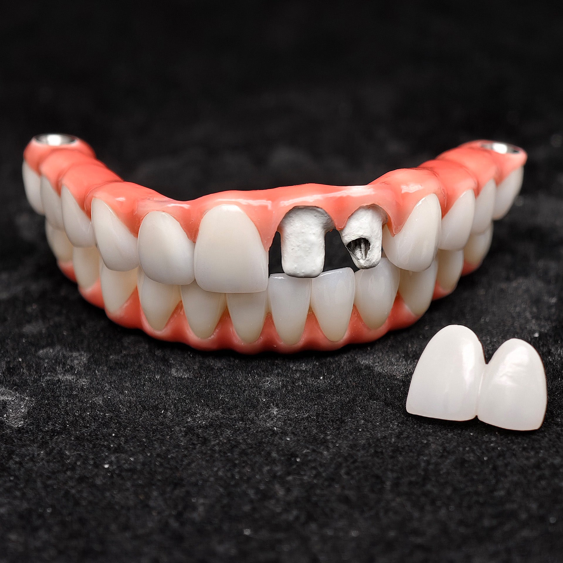 Zirconia-Enamel Hybrid Malo Bridge