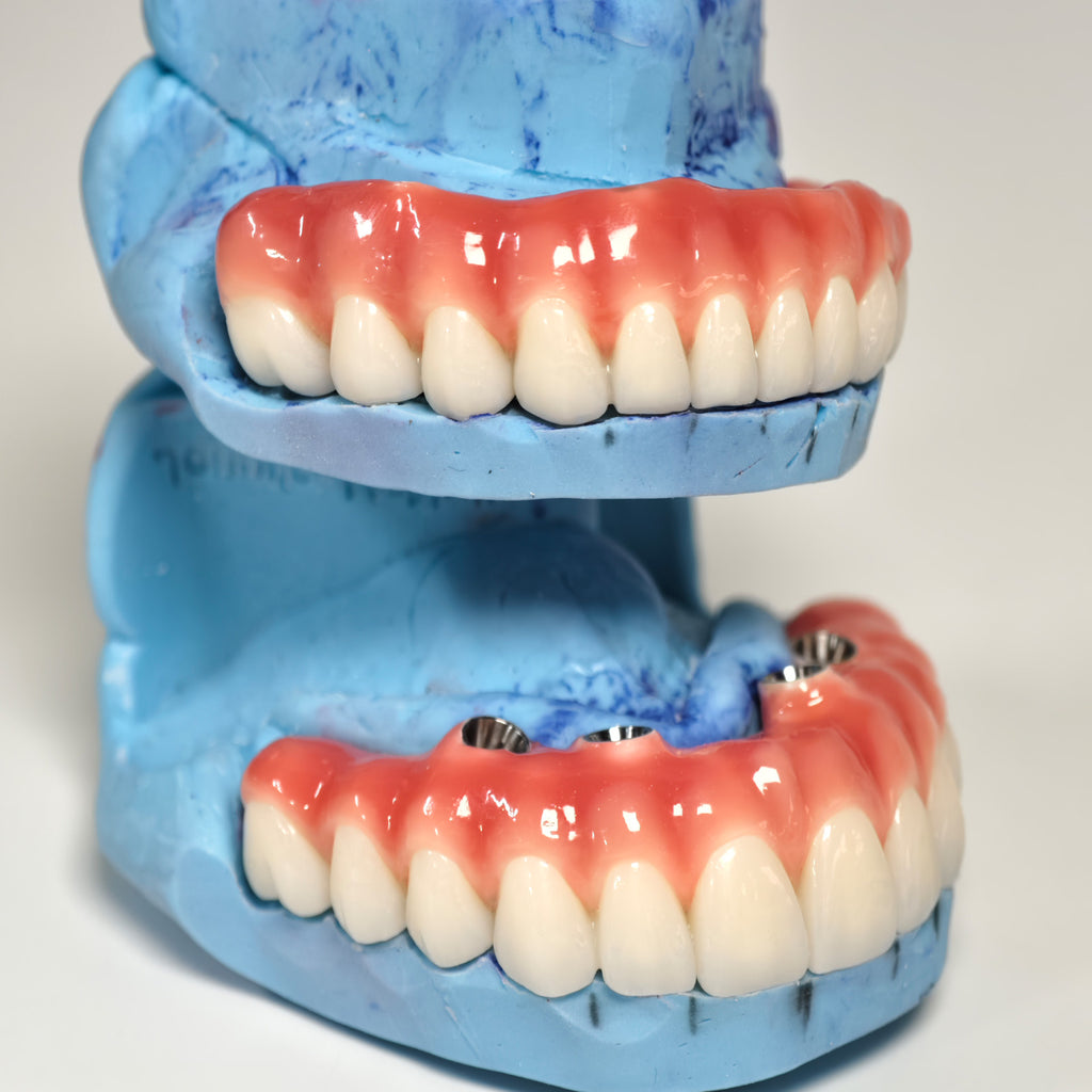 Zirconia-Enamel Hybrid Malo Bridge