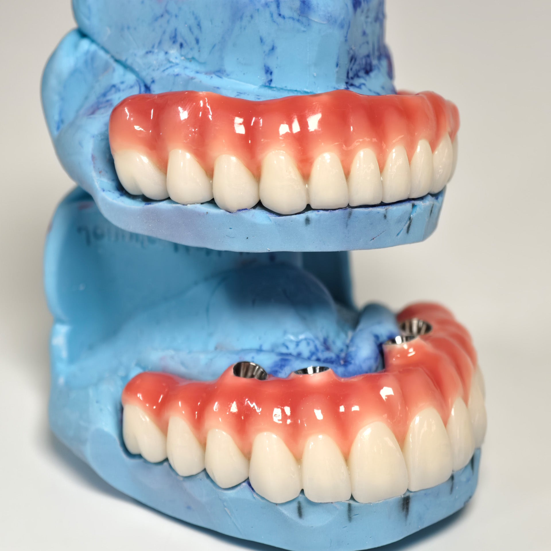 Zirconia-Enamel Hybrid Malo Bridge