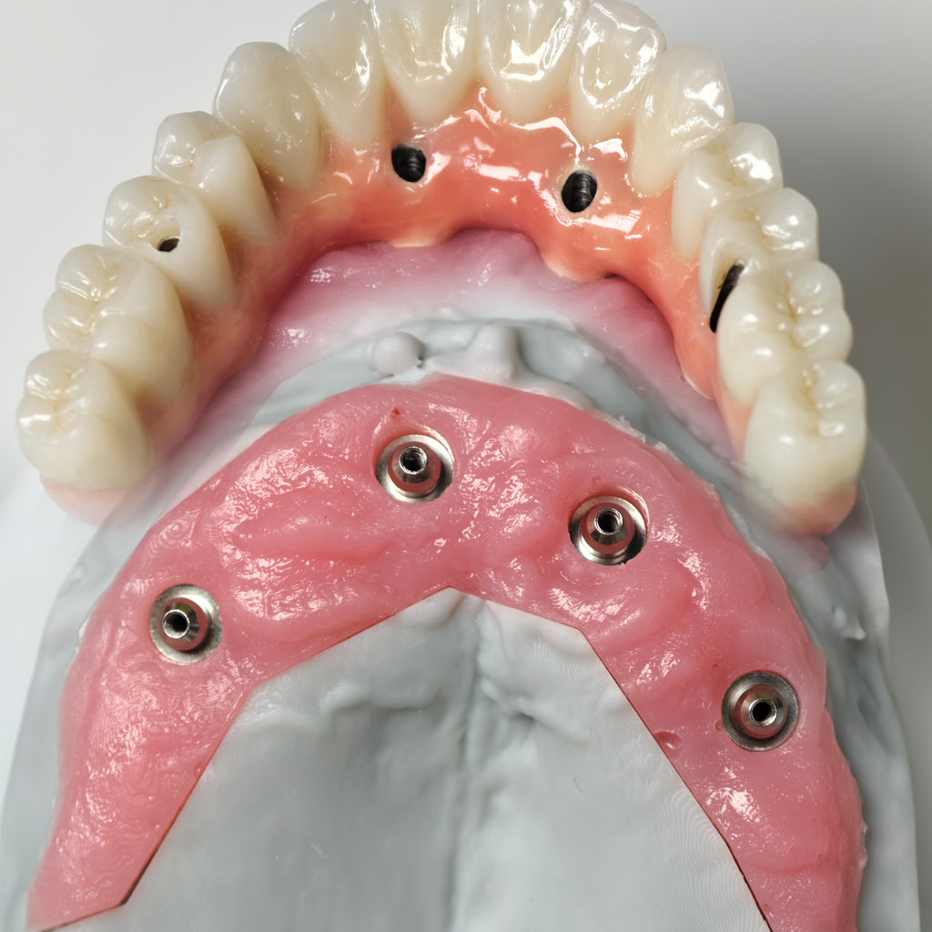 Zirconia-Enamel Hybrid Malo Bridge