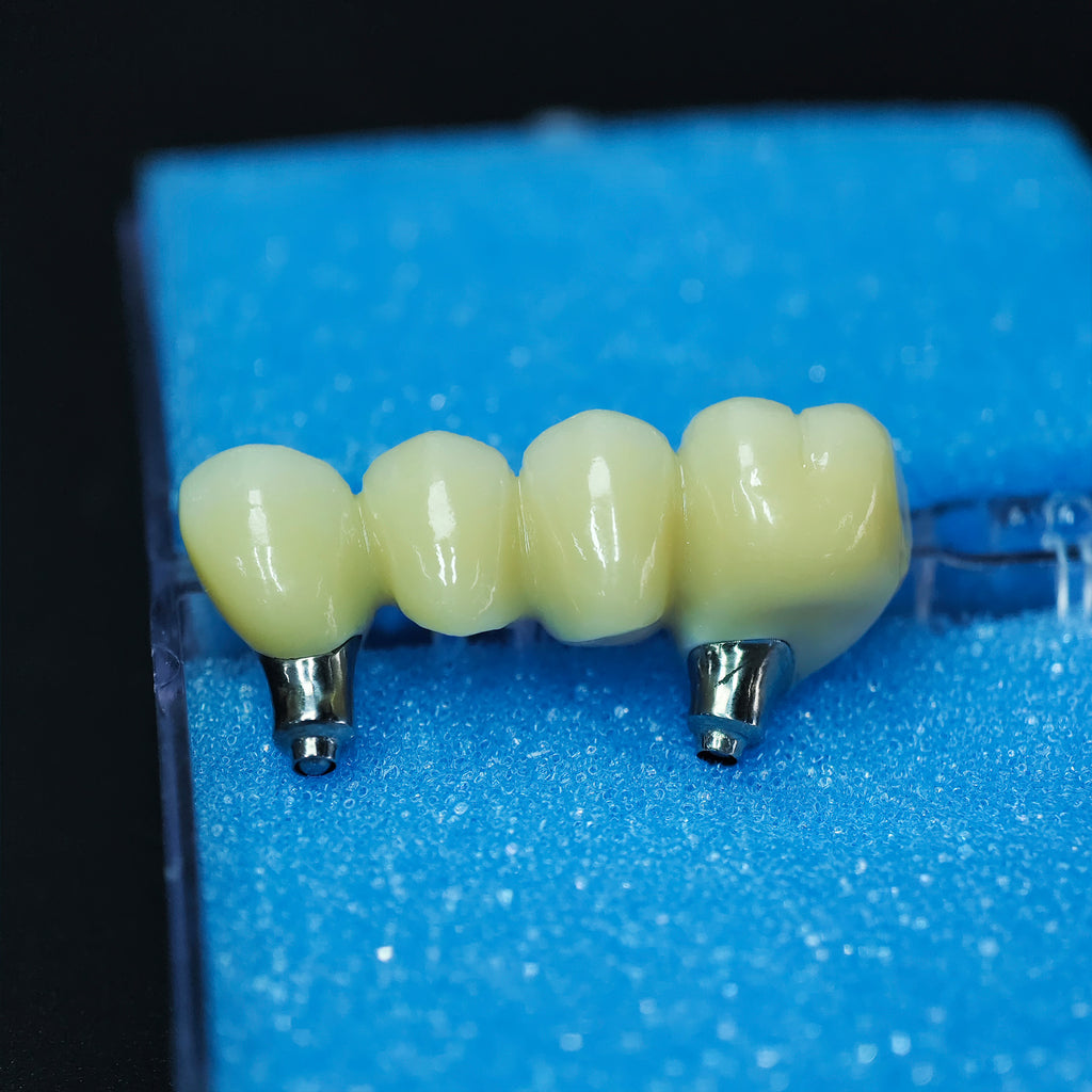 Zirconia Bridge With Screw Retained