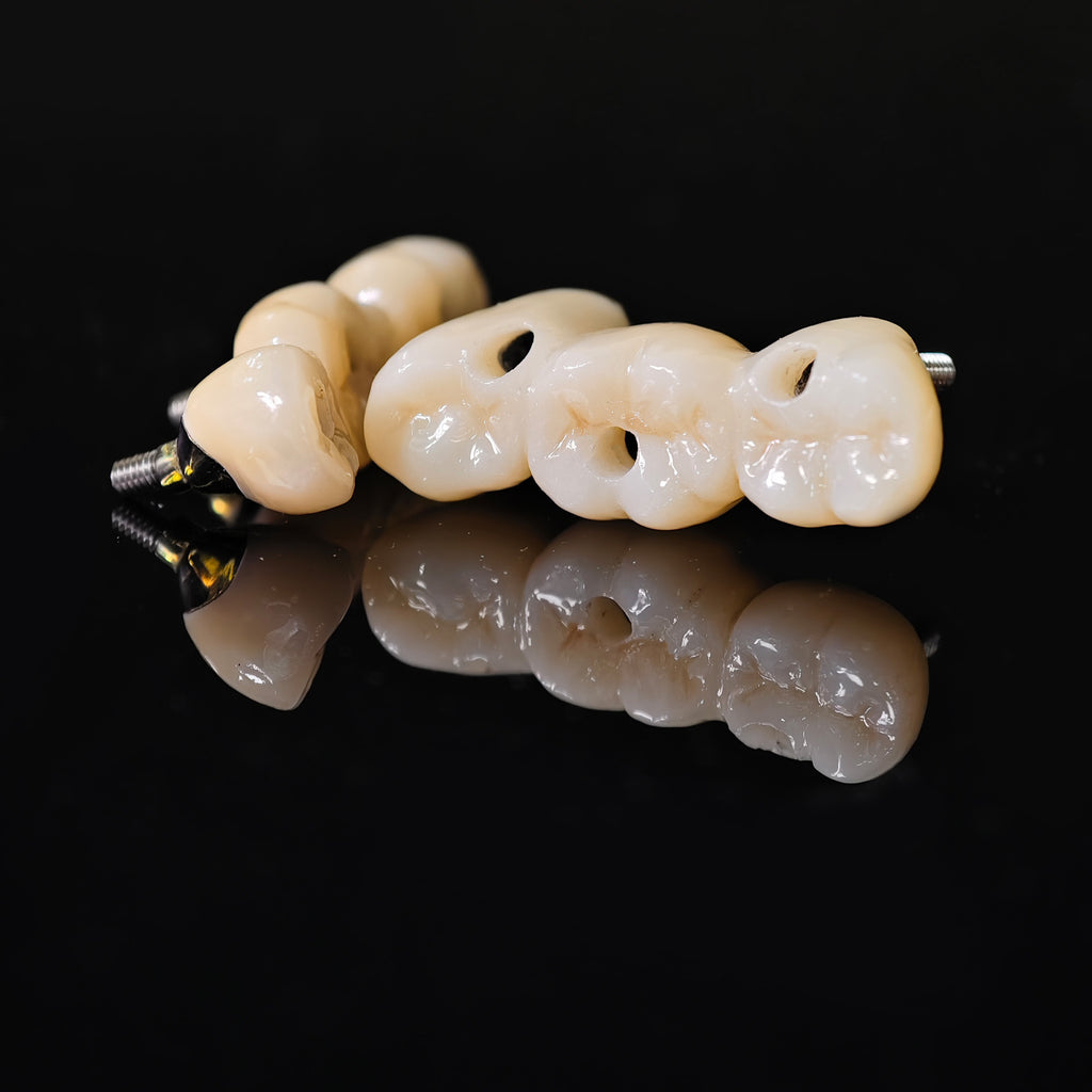 Zirconia Bridge With Screw Retained Gold Plating