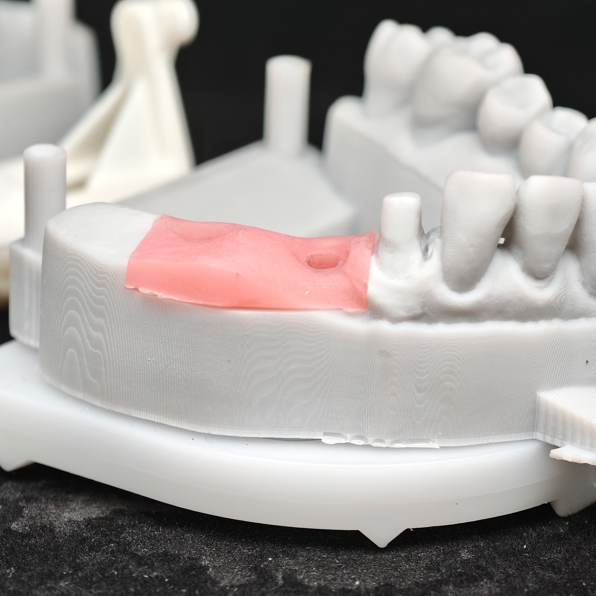 Zirconia Crown And Bridge With Screw Retained