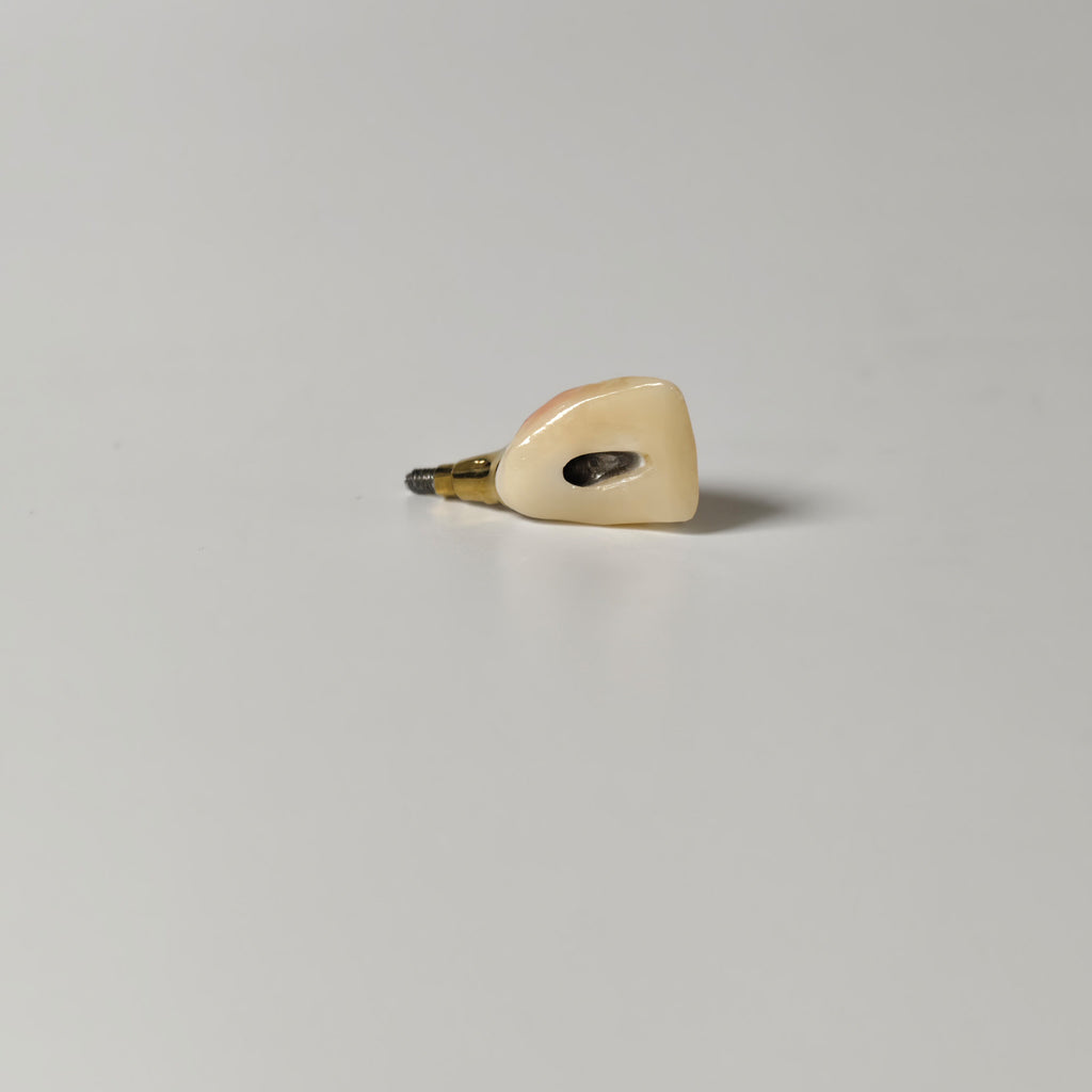 Zirconia Crown With Gold-Plated Abutment