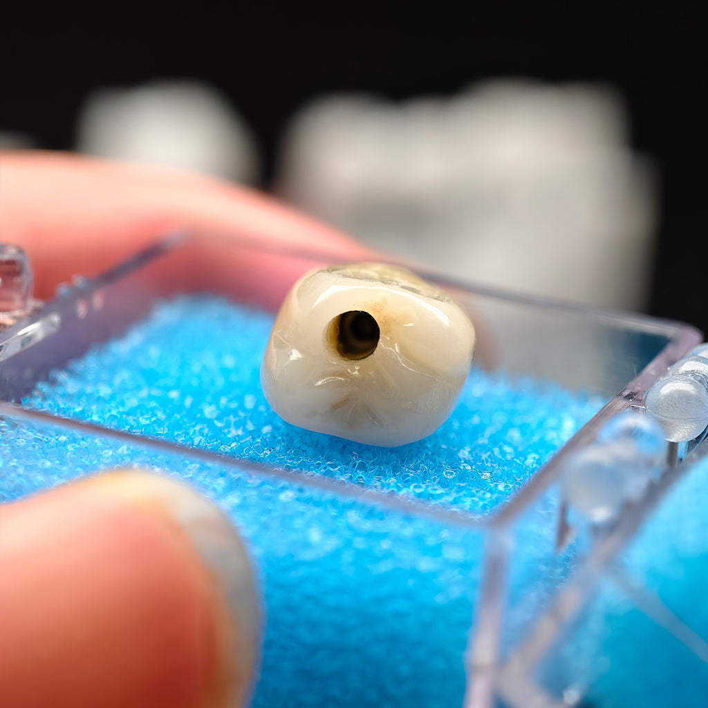 Zirconia Crown With Screw Retained