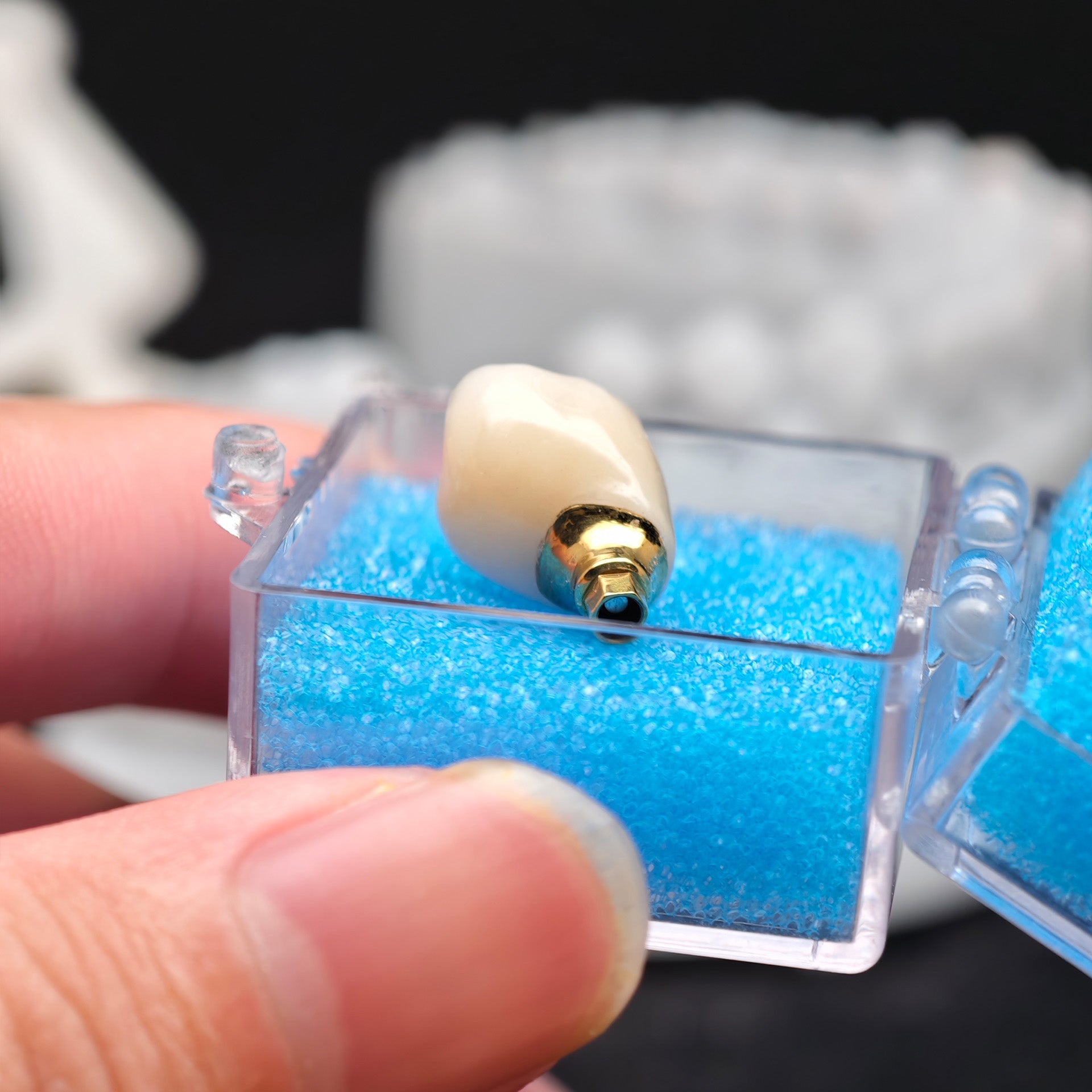 Zirconia Crown With Screw Retained