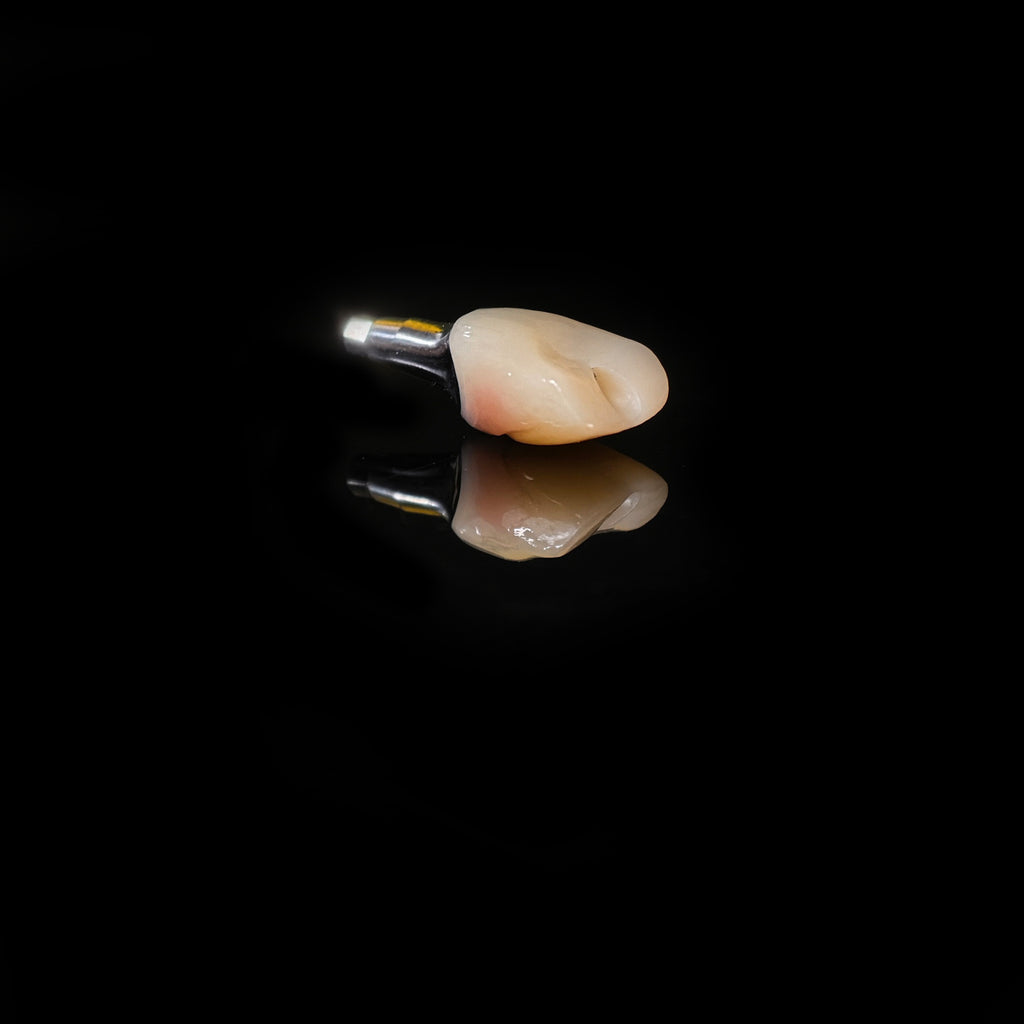Zirconia Crown With Screw Retained