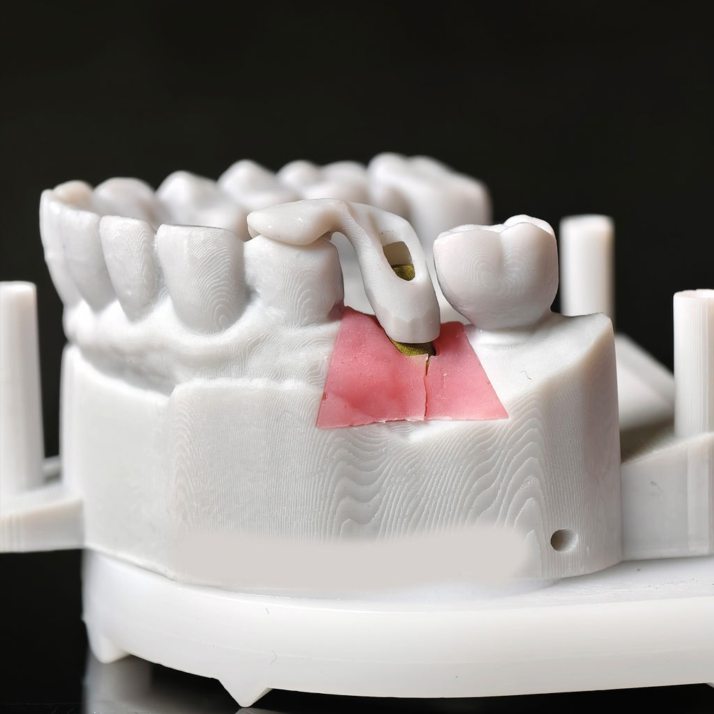 Zirconia Implant Crown Screwmentable Dental Crown