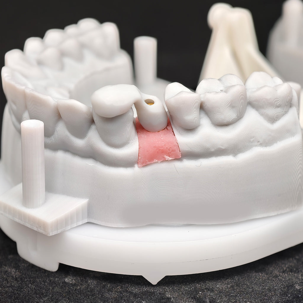 Zirconia Implant Crown Screwmentable Dental Crown
