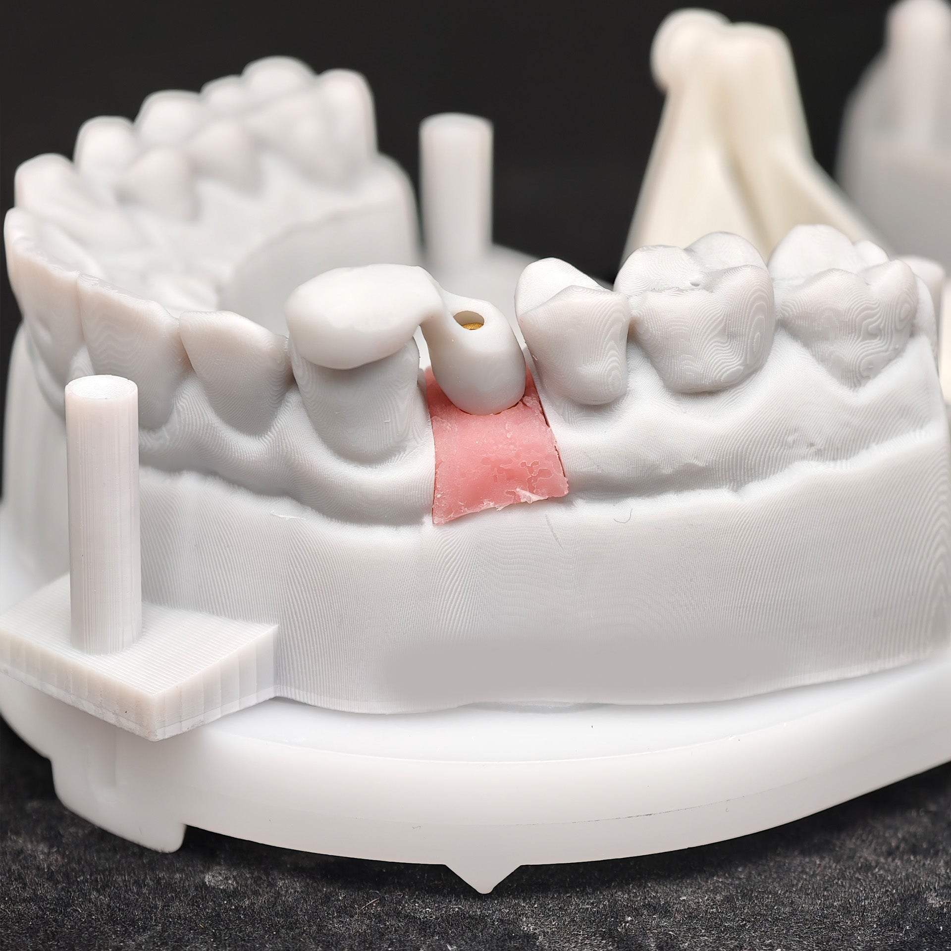 Zirconia Implant Crown Screwmentable Dental Crown