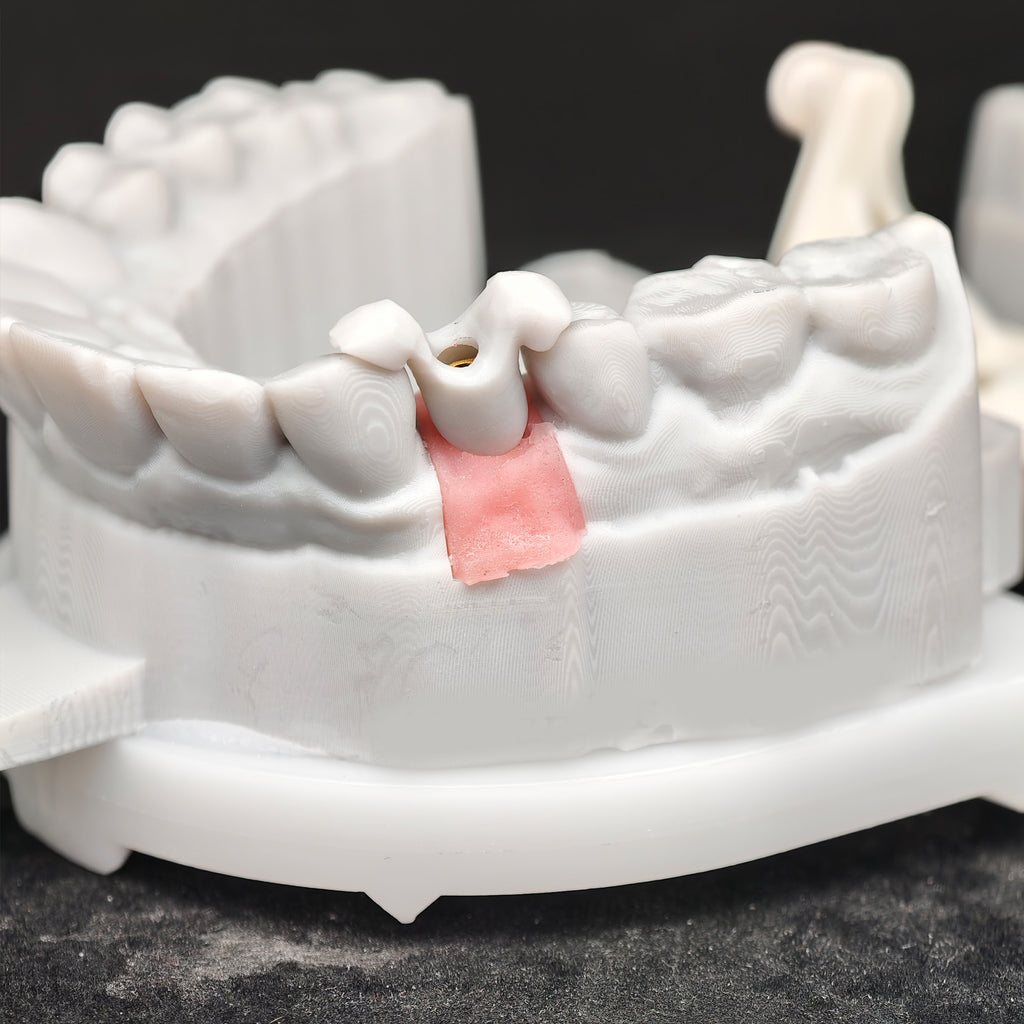 Zirconia Implant Crown Screwmentable Dental Crown