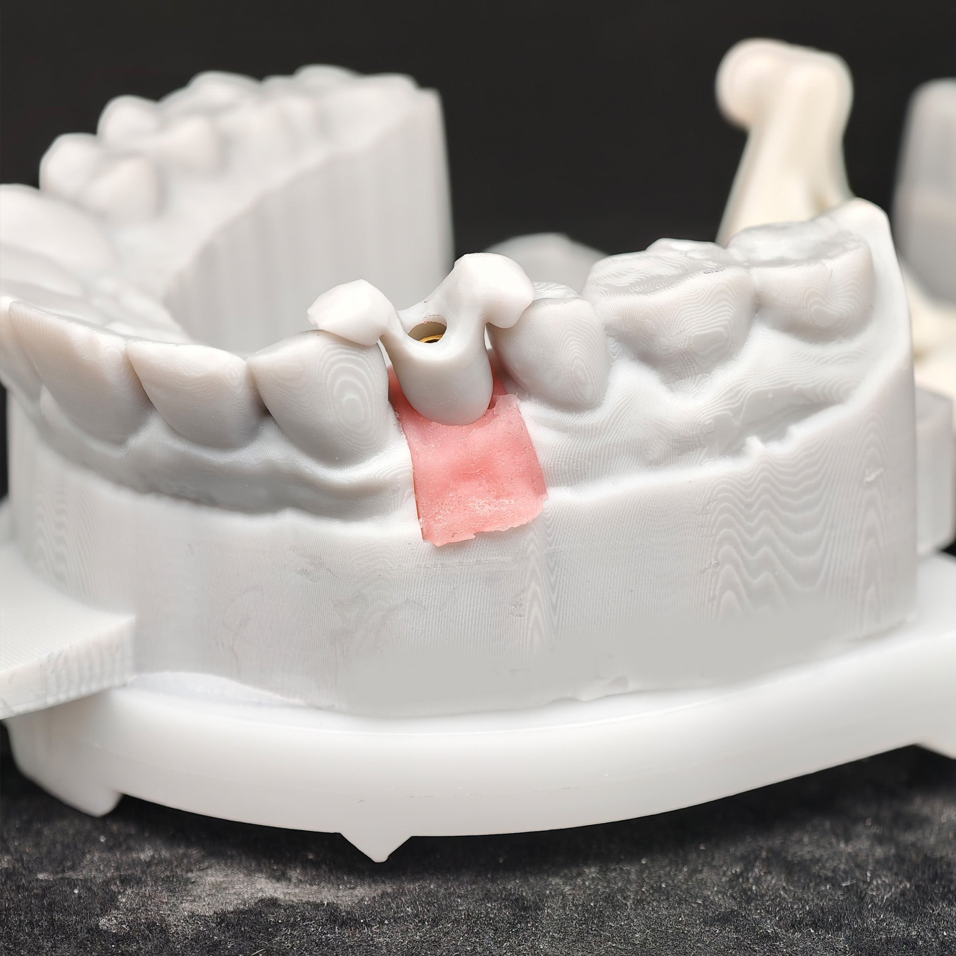 Zirconia Implant Crown Screwmentable Dental Crown