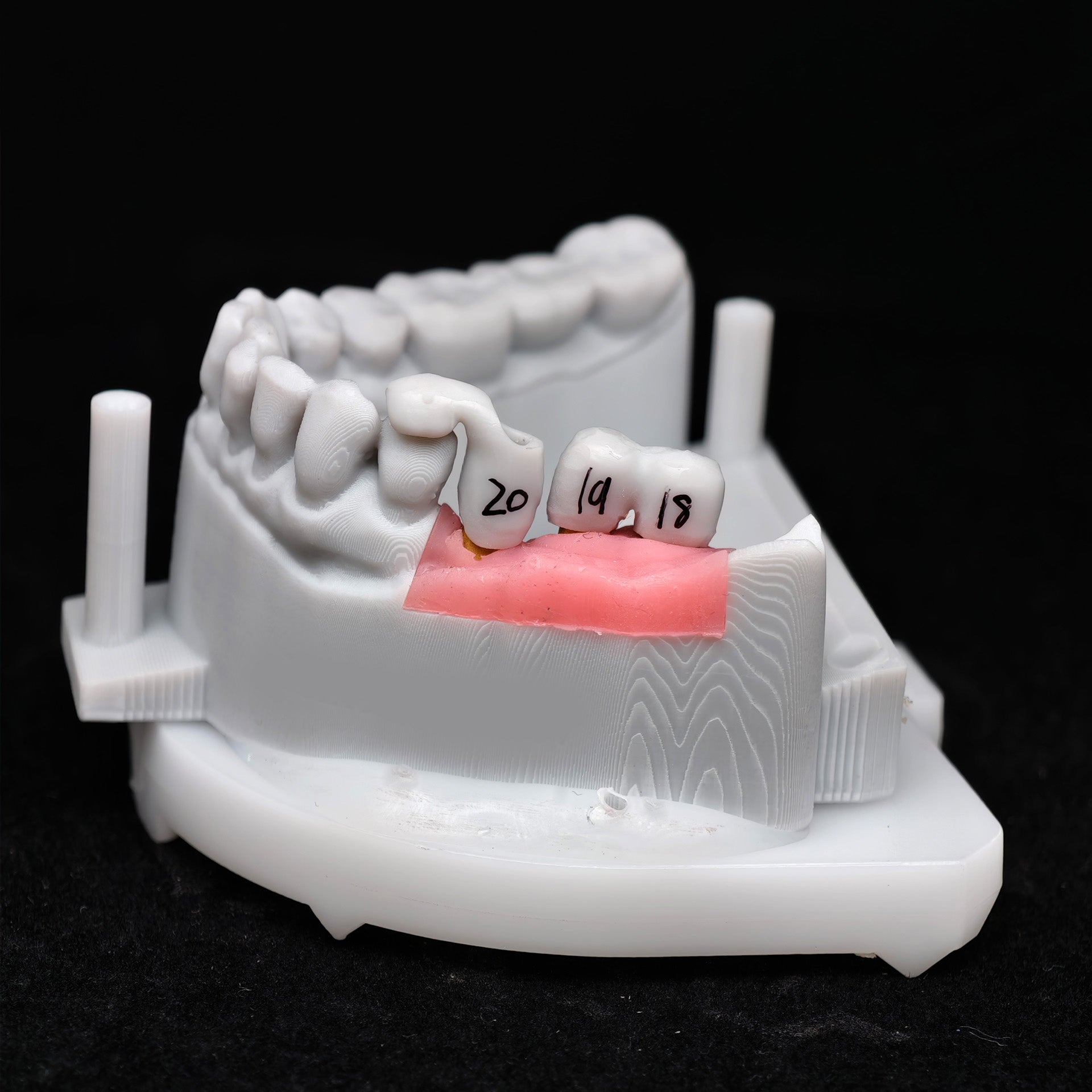 Zirconia Implant Crown Screwmentable Dental Crown