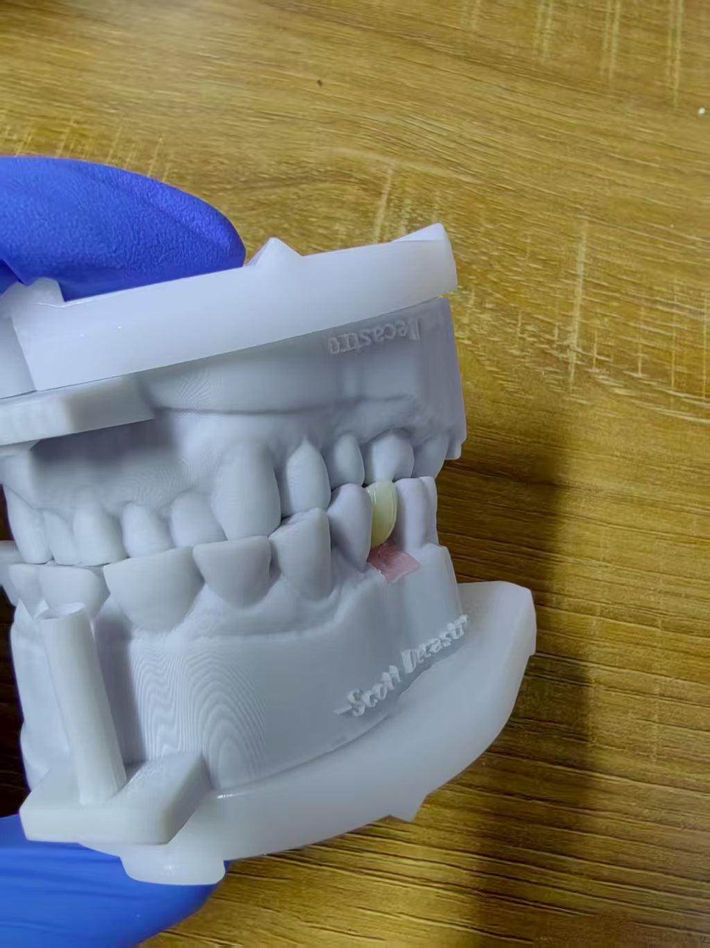 Zirconia Implant Crown Screwmentable Dental Crown