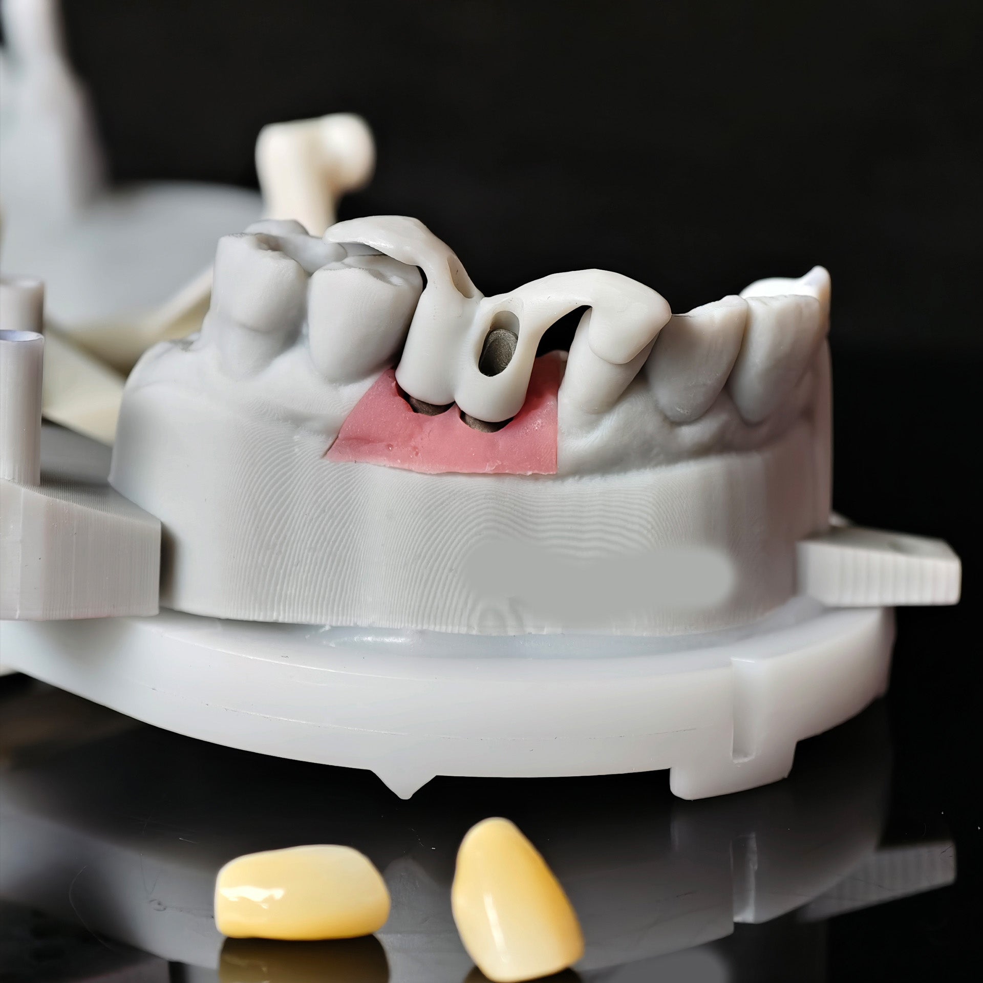 Zirconia Implant Crowns Screwmentable Dental Crown With Gold Plating