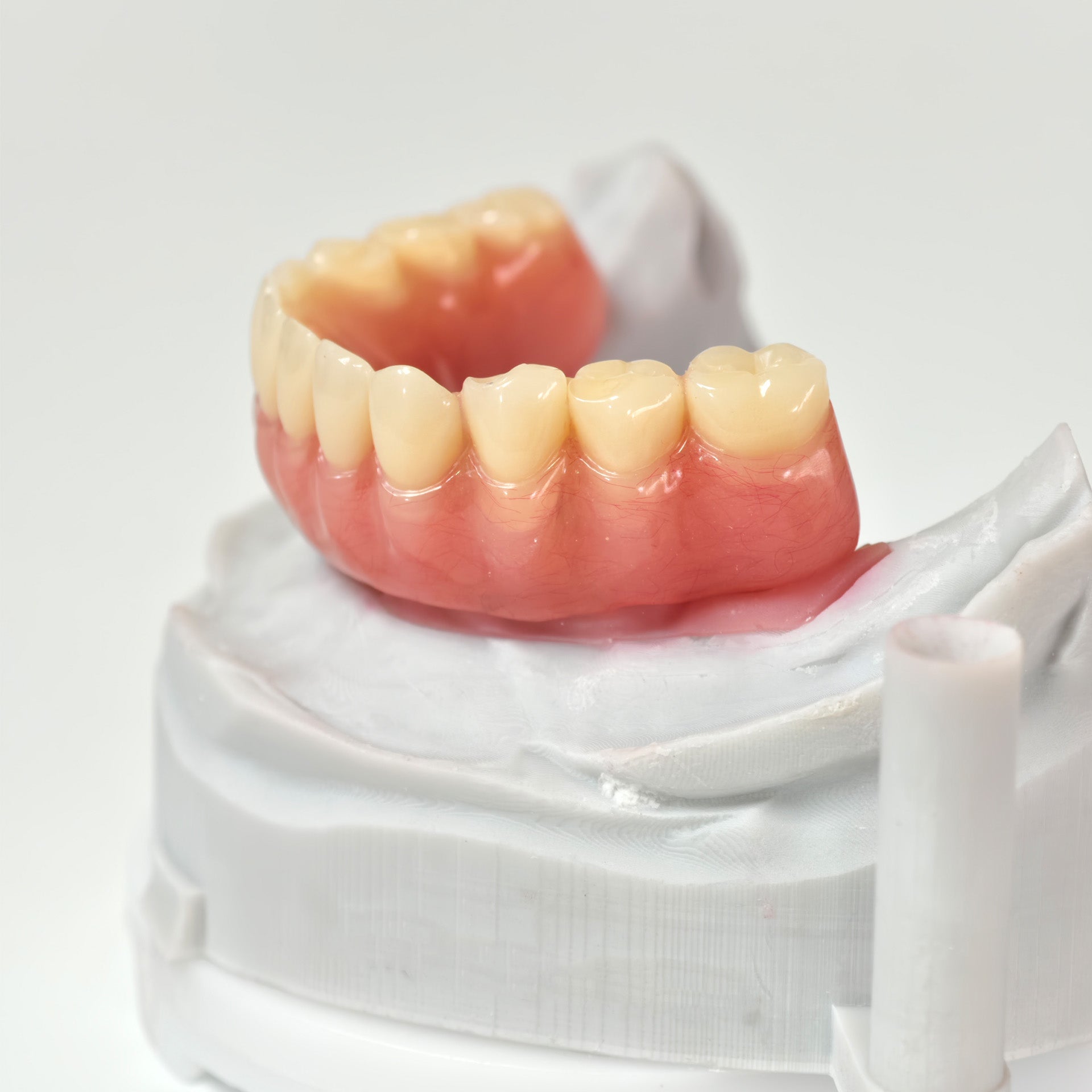 Acrylic Denture With Ti-Bar And Screw Retained