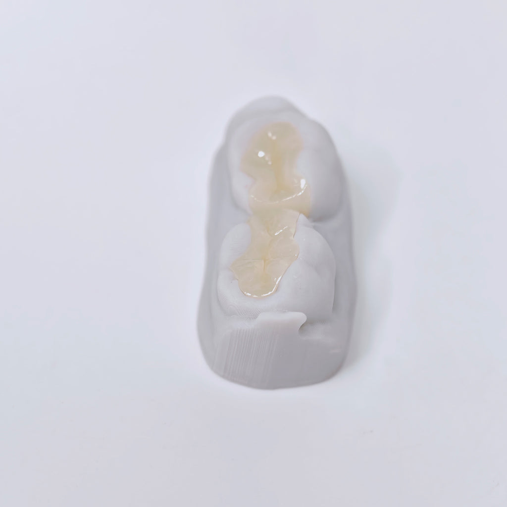 Full-Zirconia Laying With Cement-Retained