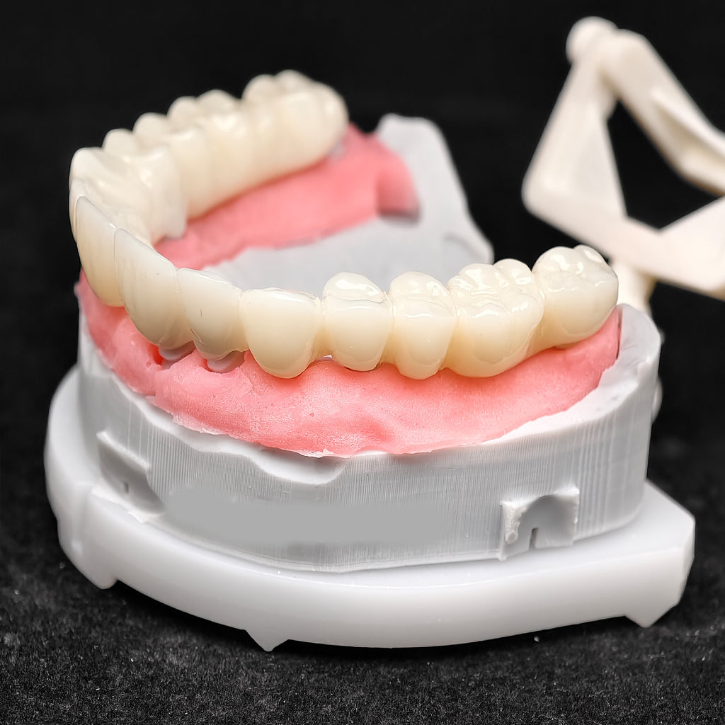 Pmma Bridge With Implant Seating Guide And Cemented