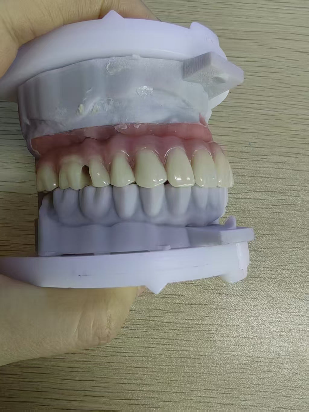 An Acrylic Denture With A Titanium Bar (Ti-Bar) Cost-Effective Full Arch Restoration Screw Retained