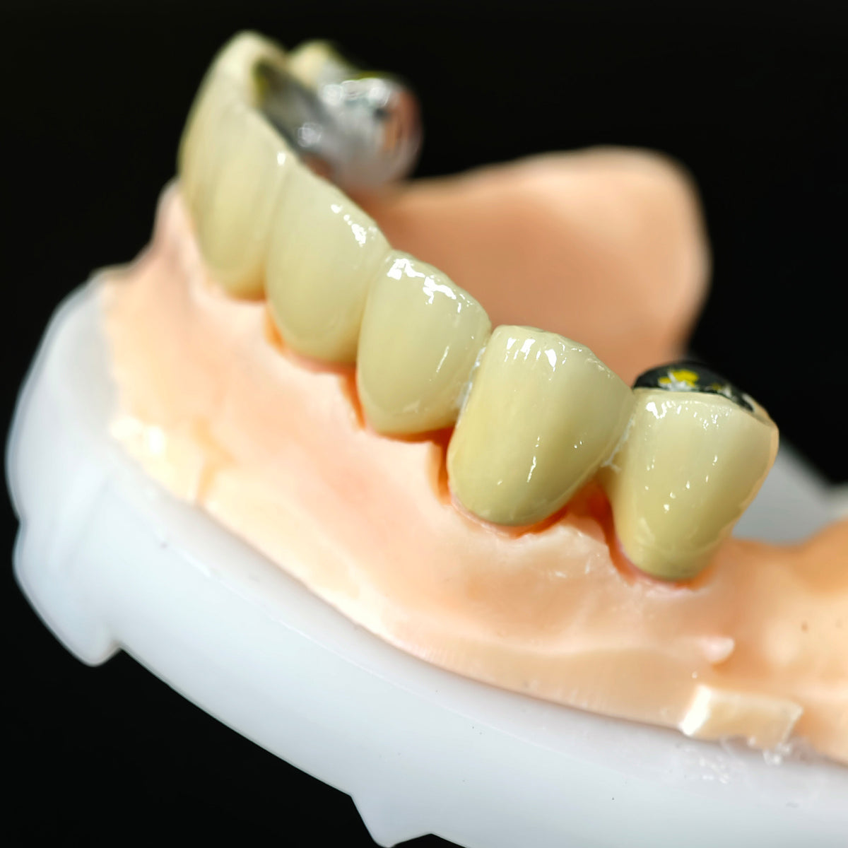 Co - Cr PFM Dental Bridge