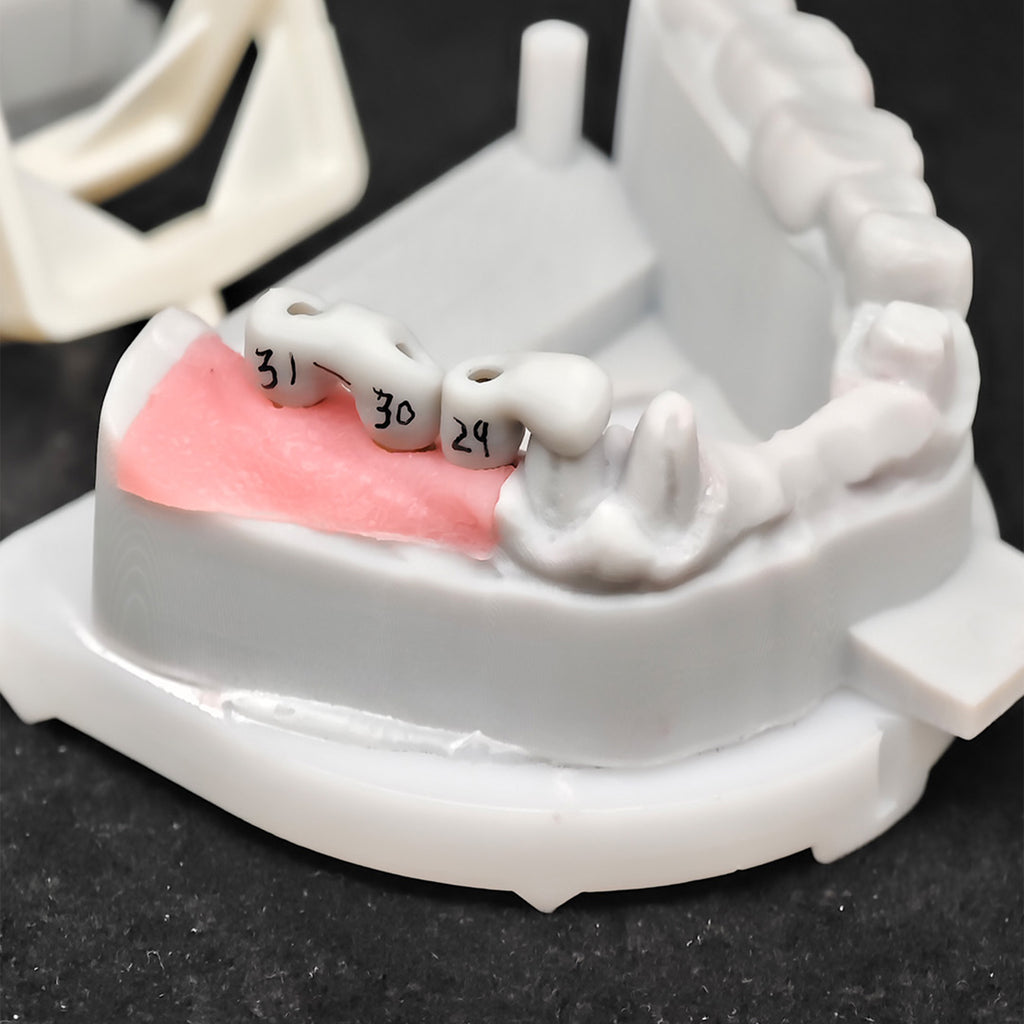 Co - Cr PFM Dental Bridge