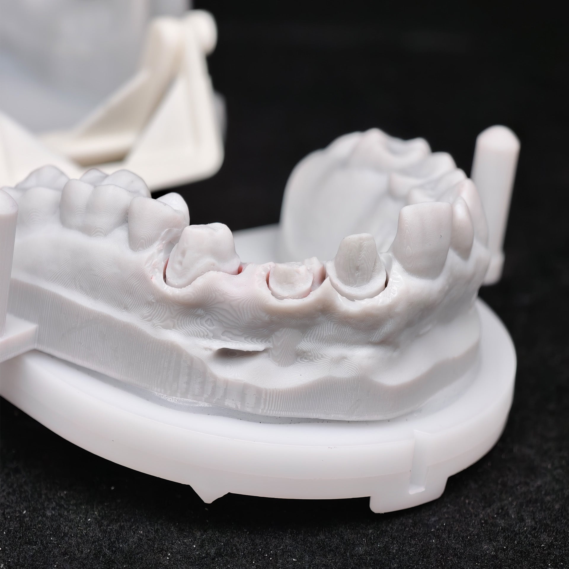 Co - Cr PFM Dental Bridge With Metal Post-And-Core