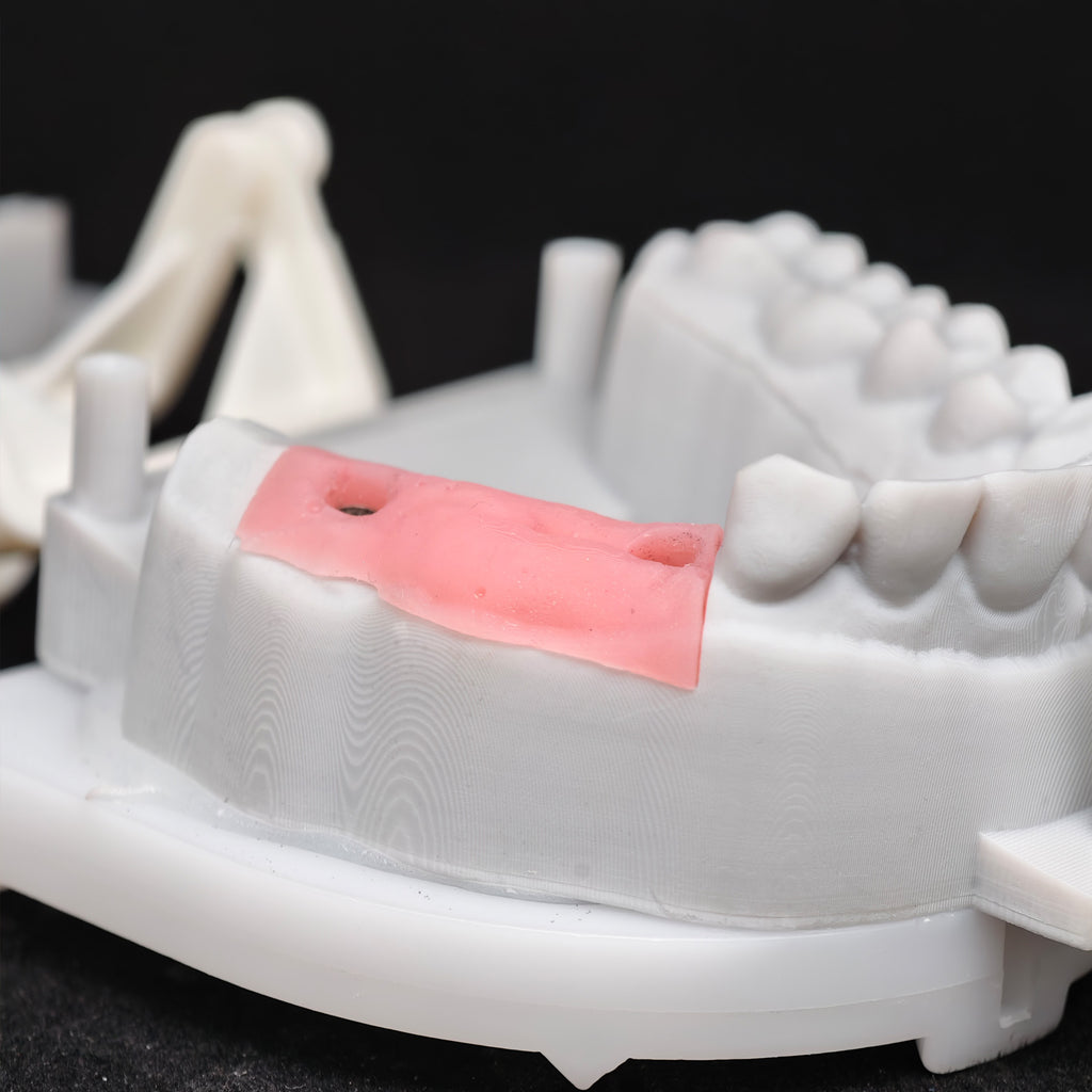 Custom Zirconia Implant Bridge