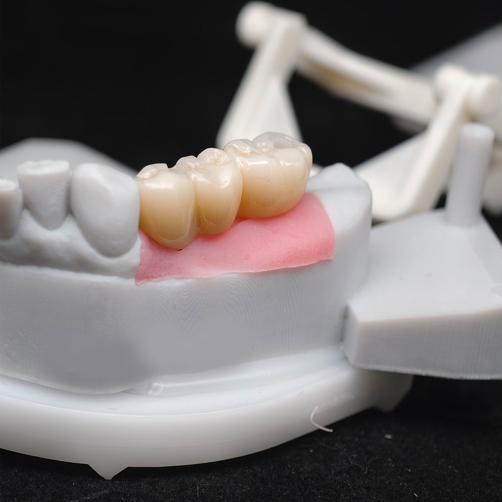 Custom Zirconia Implant Bridge