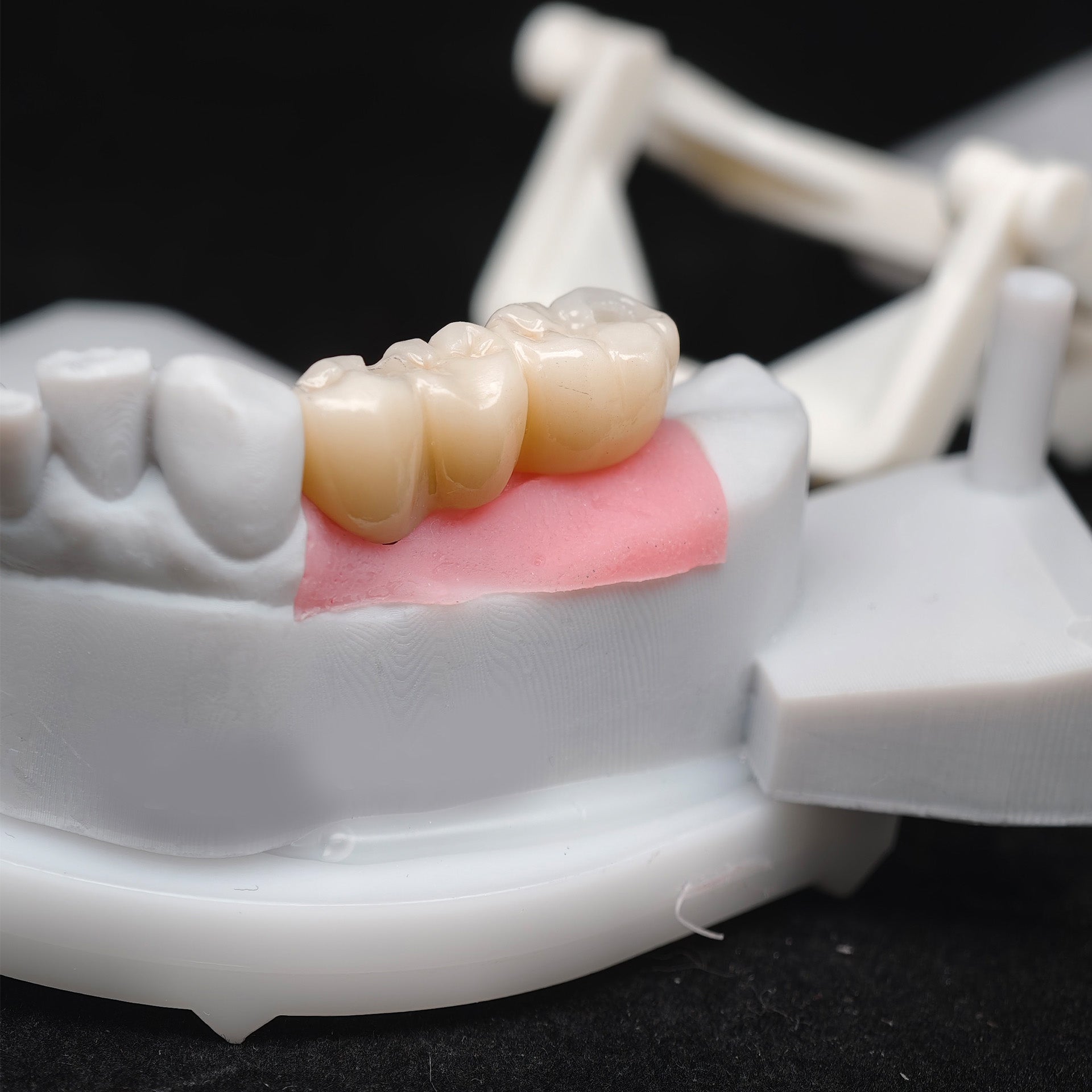 Custom Zirconia Implant Bridge