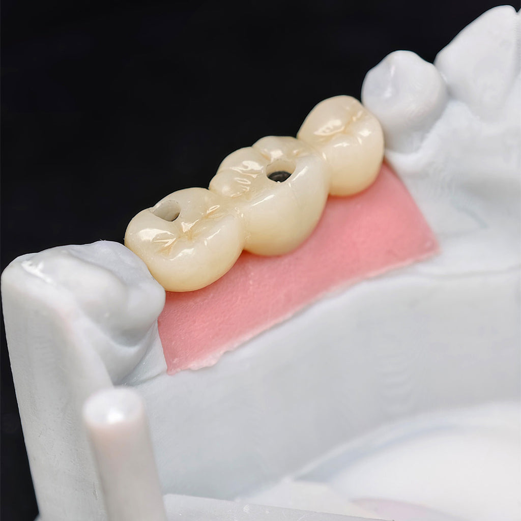 Custom Zirconia Implant Bridge
